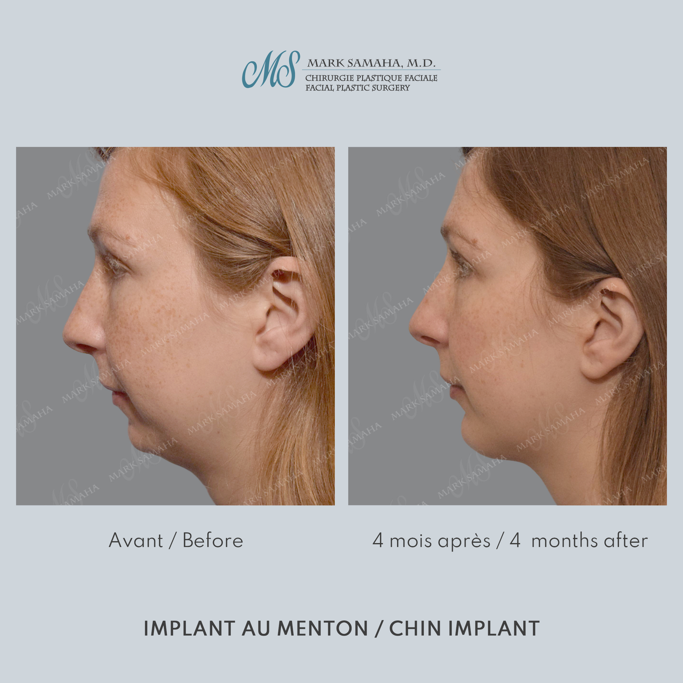 Before & After Augmentation du menton / Chin Augmentation Case 232 View #4 View in Montreal, QC