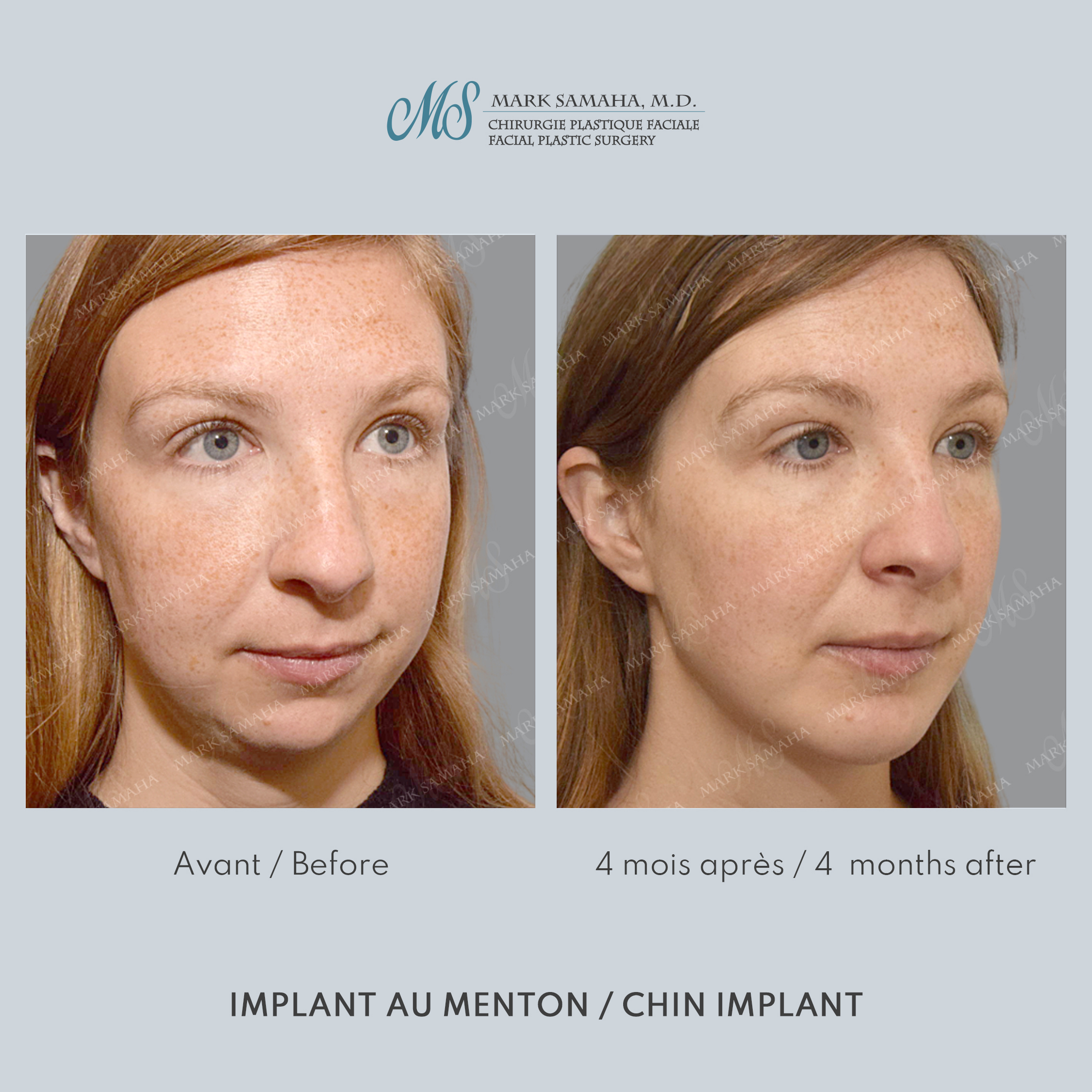 Before & After Augmentation du menton / Chin Augmentation Case 232 View #5 Detail View in Montreal, QC