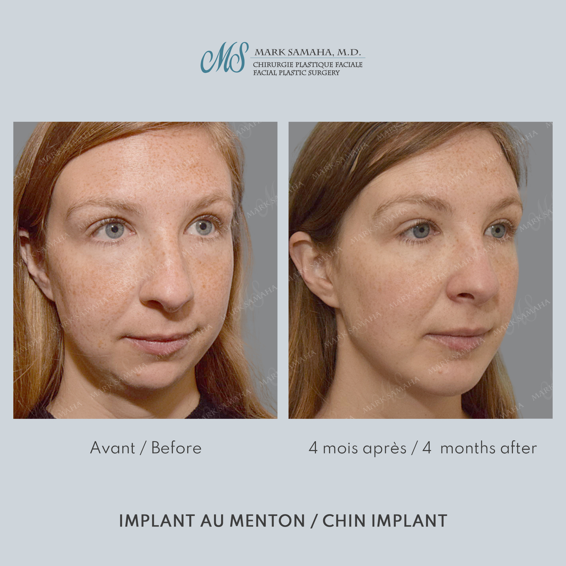 Before & After Augmentation du menton / Chin Augmentation Case 232 View #5 View in Montreal, QC