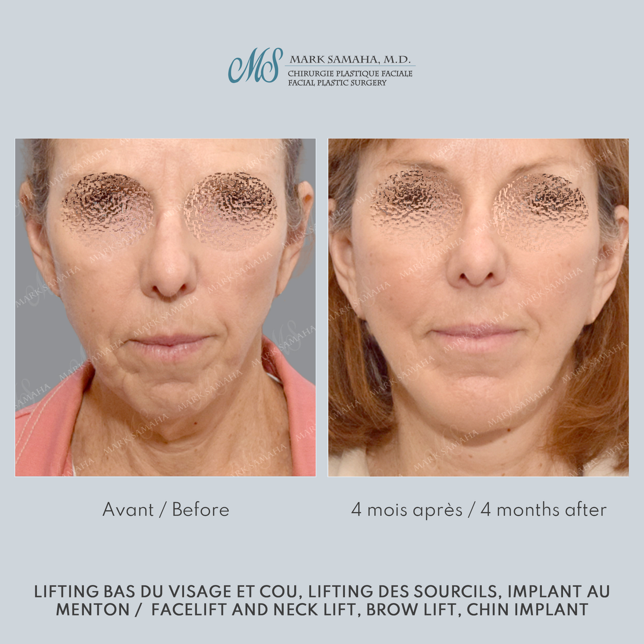 Before & After Augmentation du menton / Chin Augmentation Case 233 View #1 Detail View in Montreal, QC