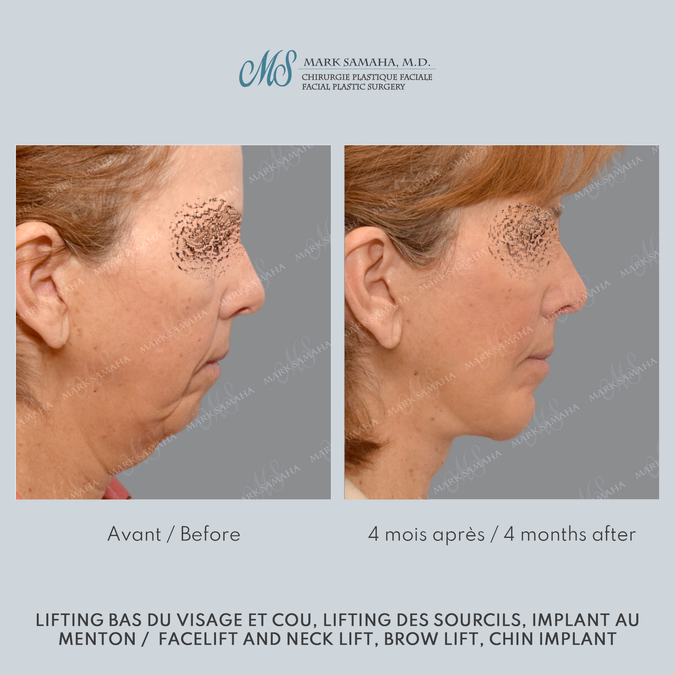 Before & After Augmentation du menton / Chin Augmentation Case 233 View #2 Detail View in Montreal, QC