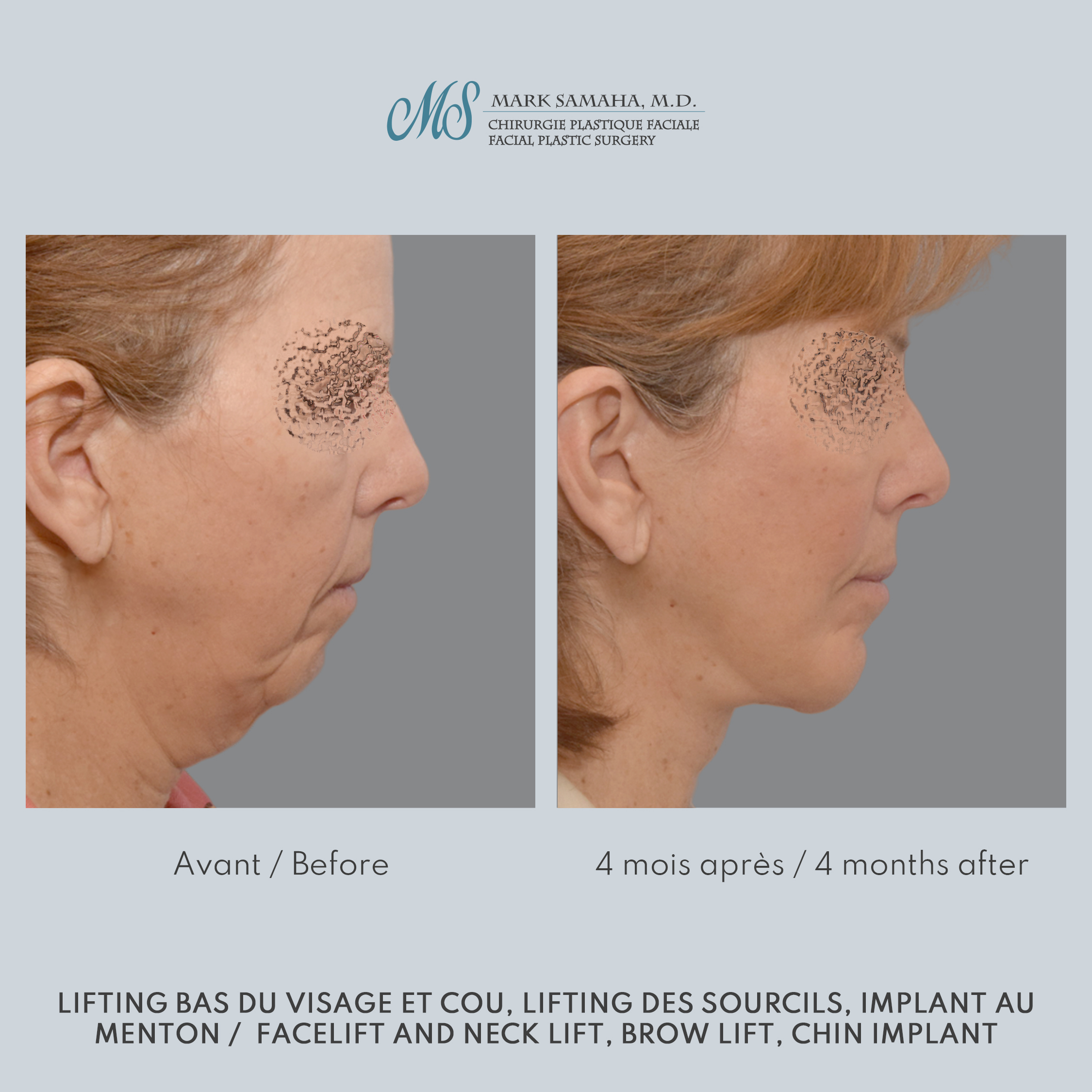 Before & After Augmentation du menton / Chin Augmentation Case 233 View #2 View in Montreal, QC