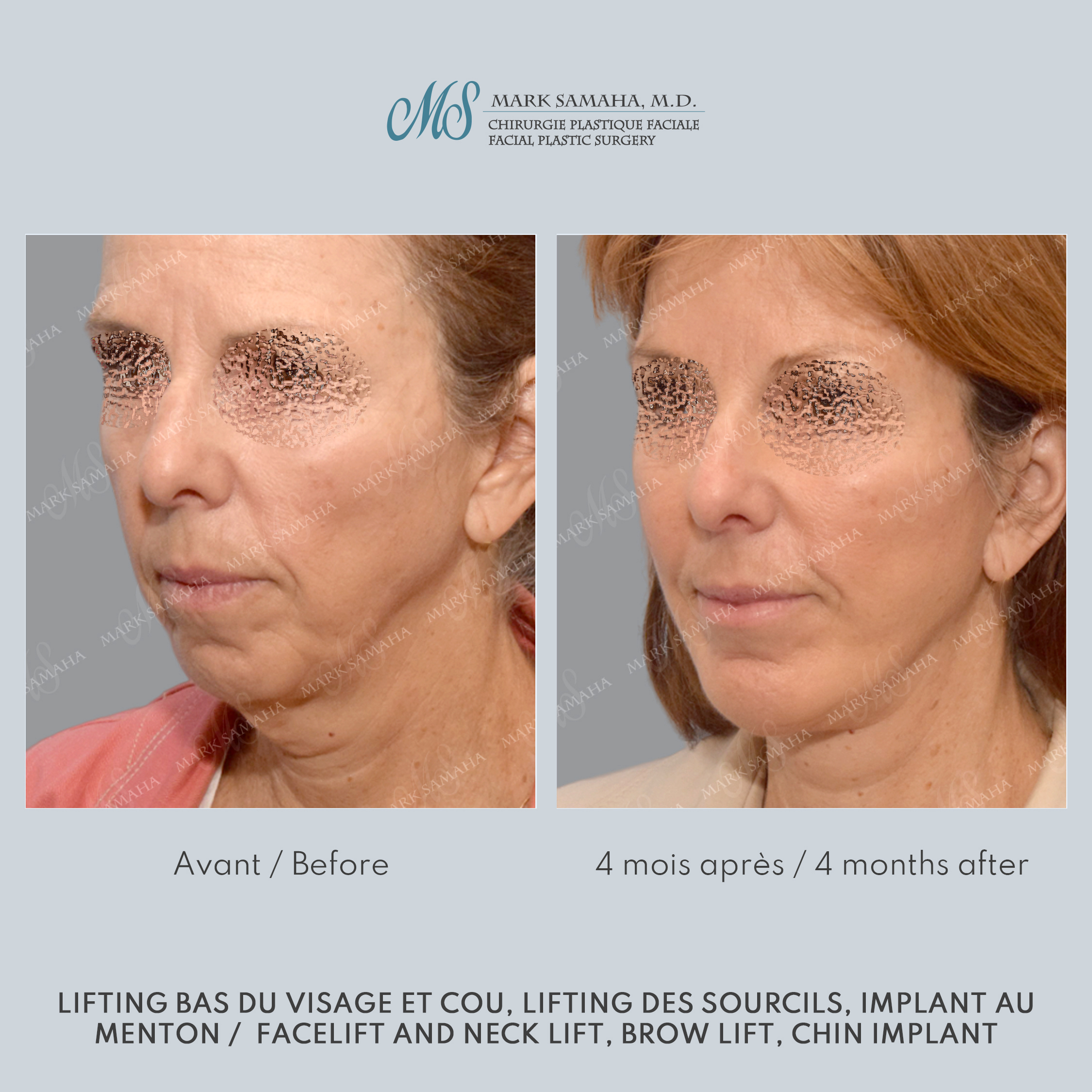 Before & After Augmentation du menton / Chin Augmentation Case 233 View #3 Detail View in Montreal, QC