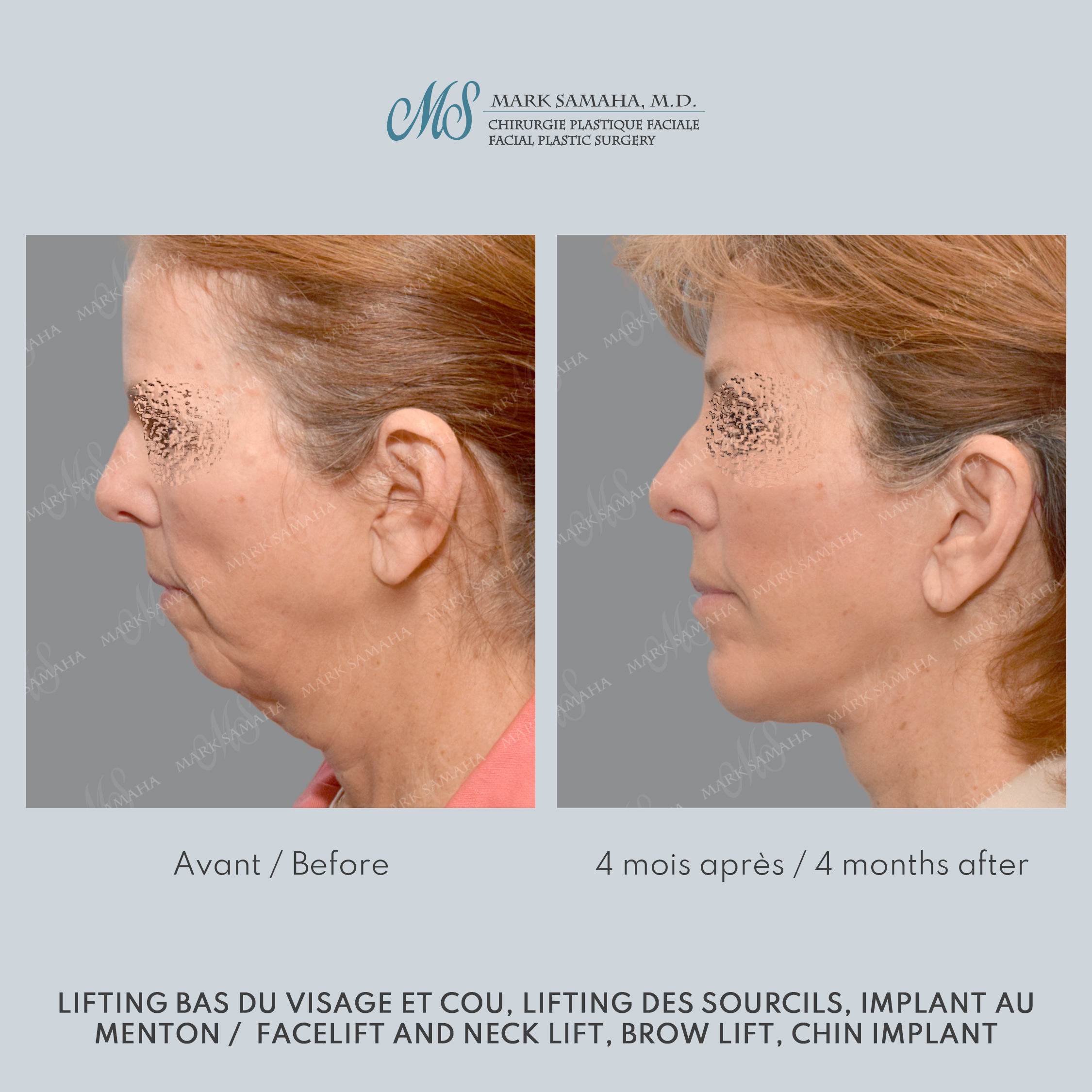 Before & After Augmentation du menton / Chin Augmentation Case 233 View #5 Detail View in Montreal, QC