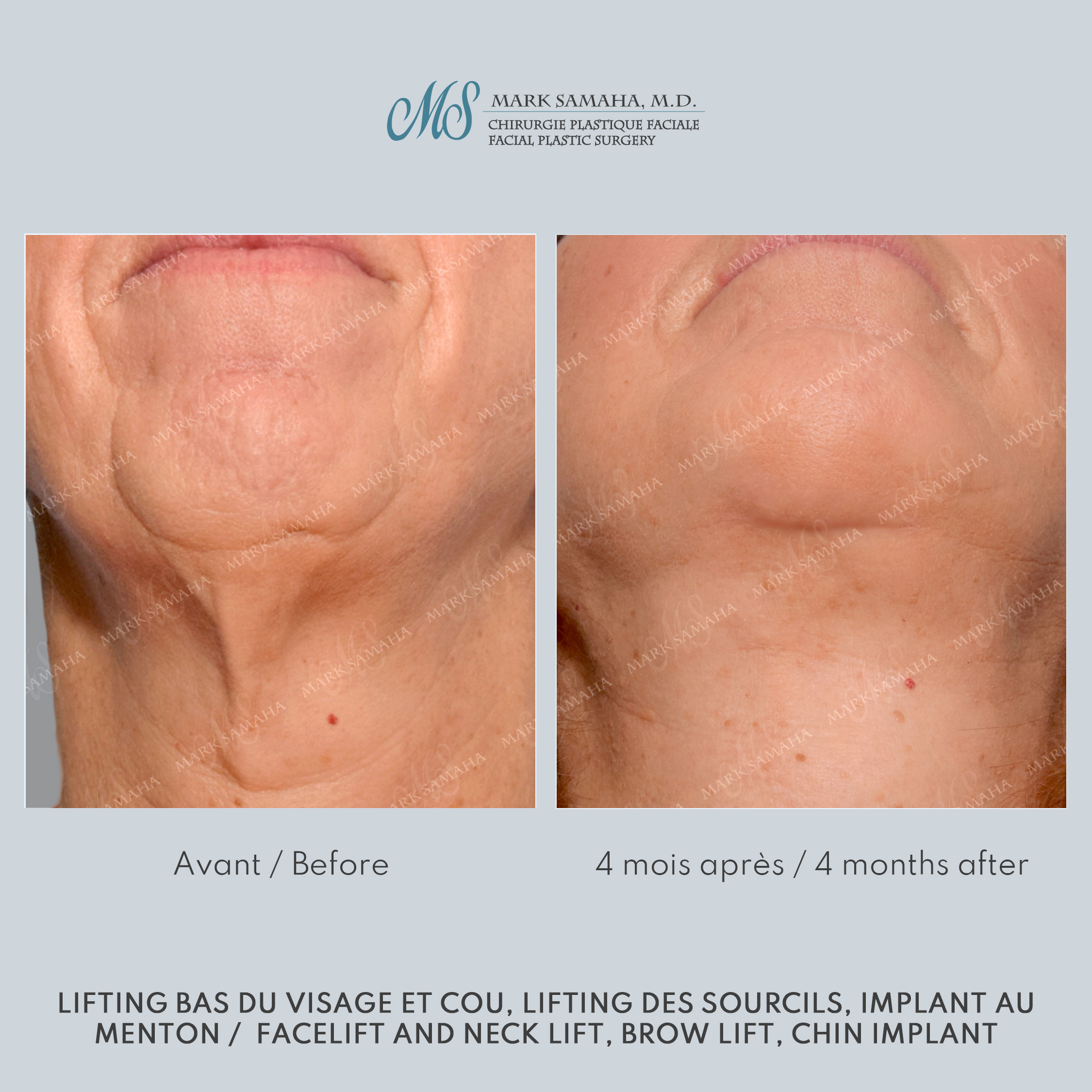 Before & After Augmentation du menton / Chin Augmentation Case 233 View #6 Detail View in Montreal, QC