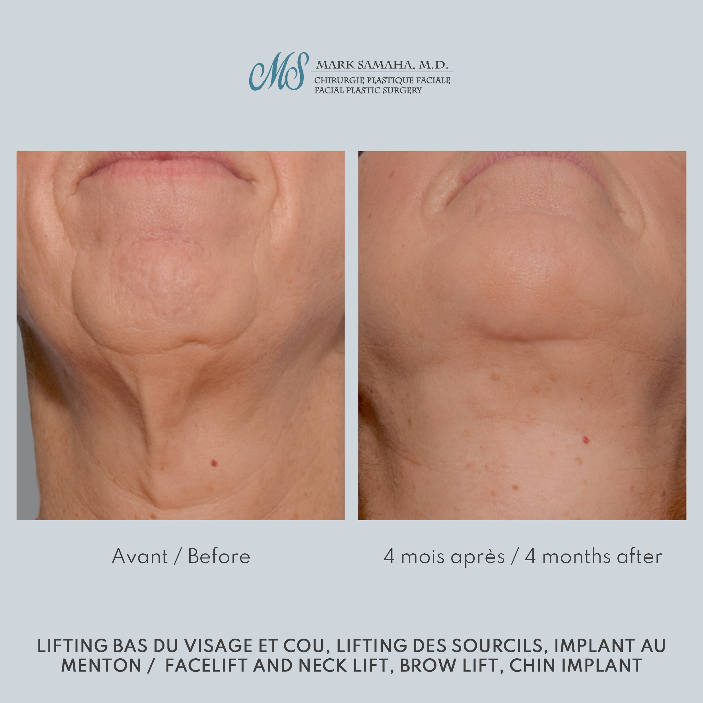 Before & After Augmentation du menton / Chin Augmentation Case 233 View #6 View in Montreal, QC
