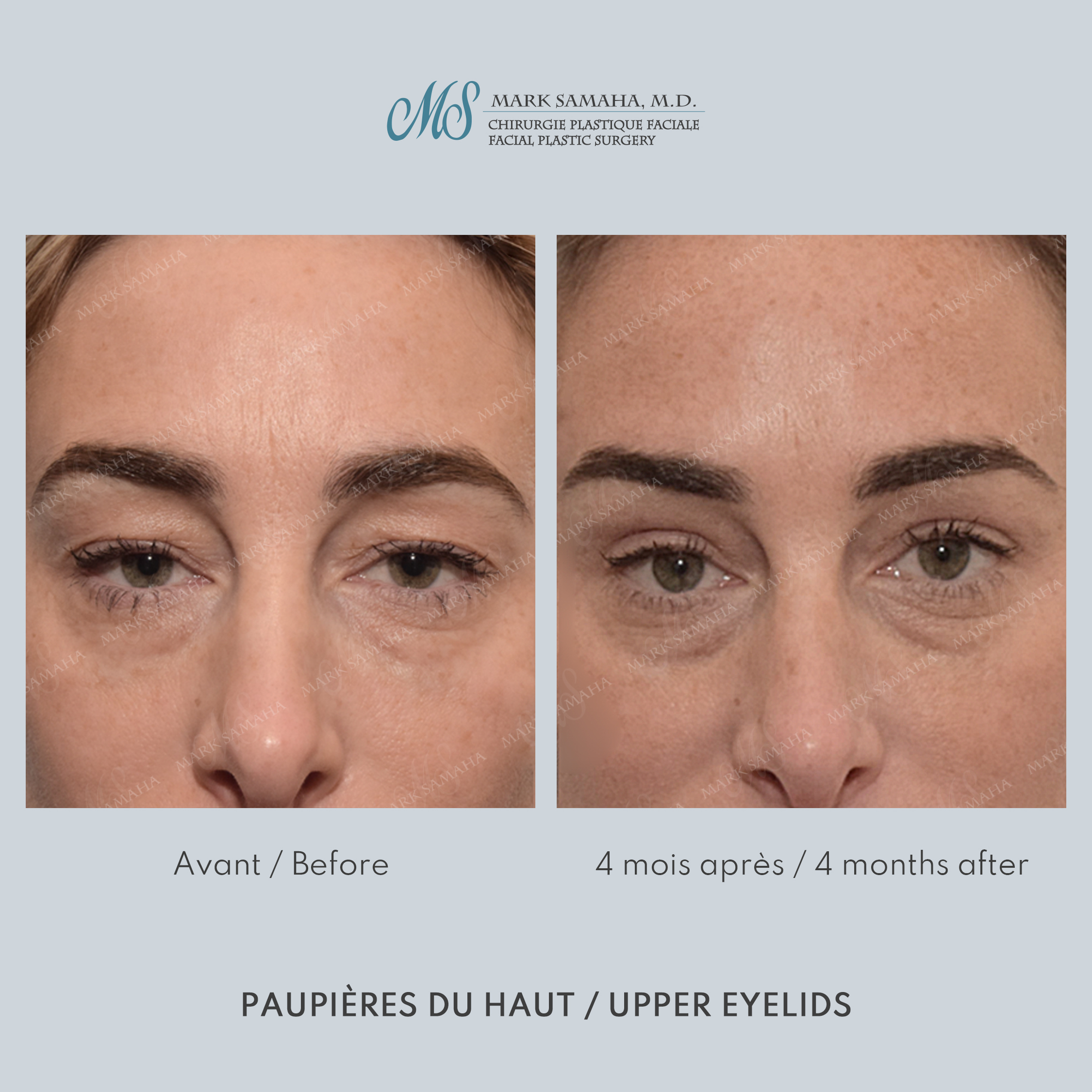 Before & After Blépharoplastie / Blepharoplasty Case 234 View #1 View in Montreal, QC