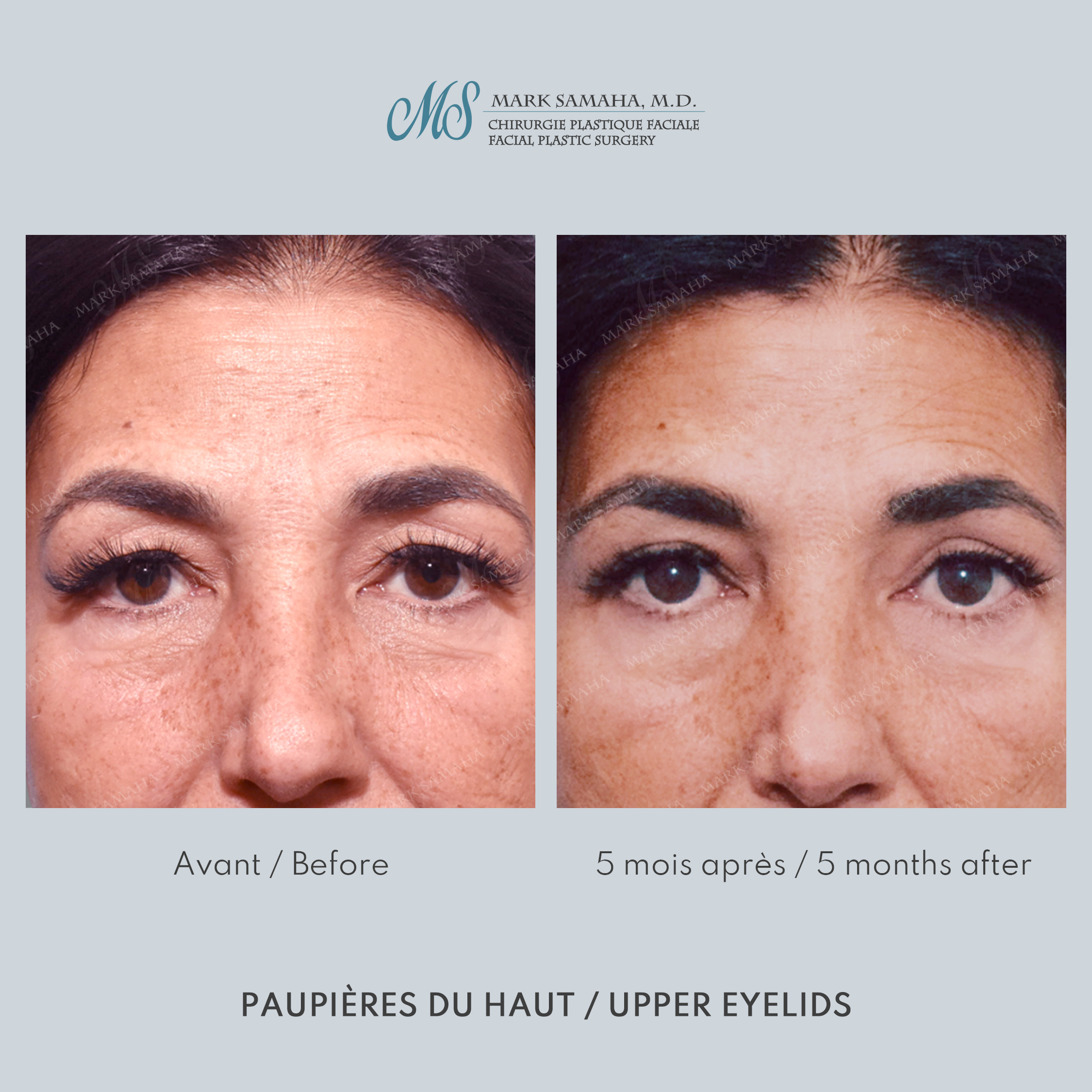 Before & After Blépharoplastie / Blepharoplasty Case 235 View #1 View in Montreal, QC