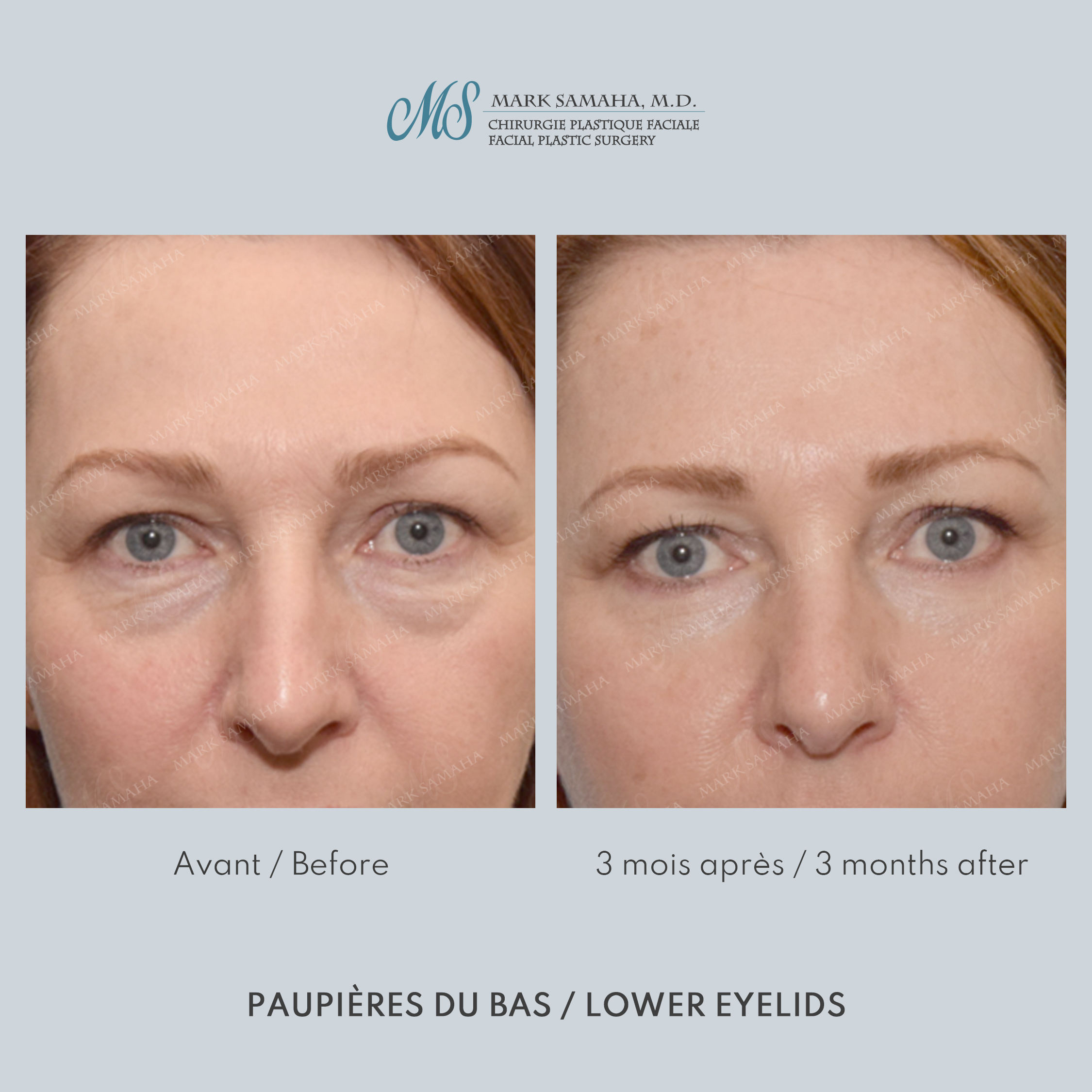 Before & After Blépharoplastie / Blepharoplasty Case 236 View #4 View in Montreal, QC