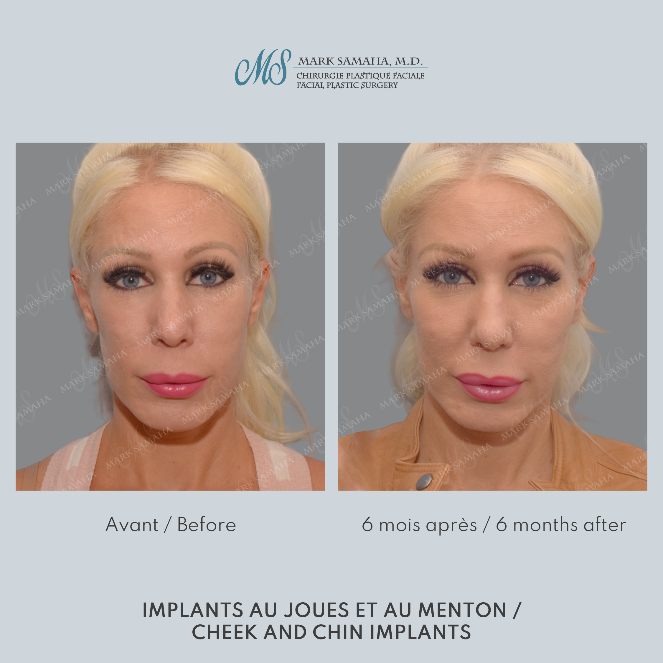 Before & After Implants aux joues / Cheek Implants Case 252 View #1 View in Montreal, QC