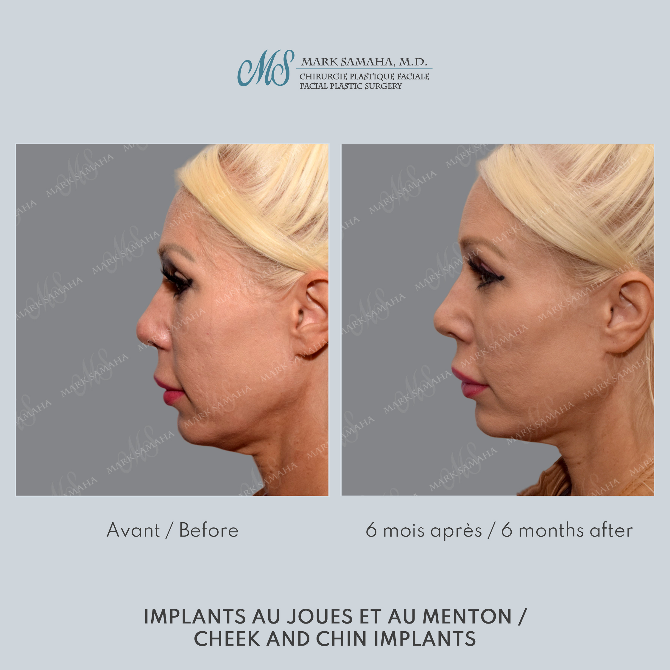 Before & After Implants aux joues / Cheek Implants Case 252 View #2 Detail View in Montreal, QC