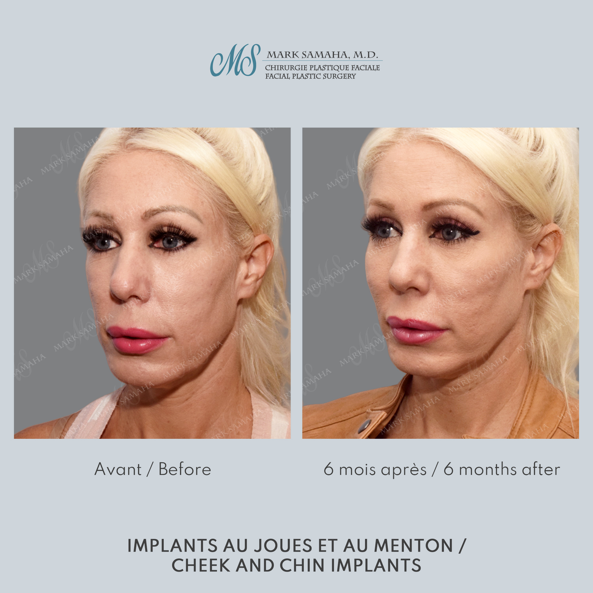 Before & After Implants aux joues / Cheek Implants Case 252 View #3 Detail View in Montreal, QC