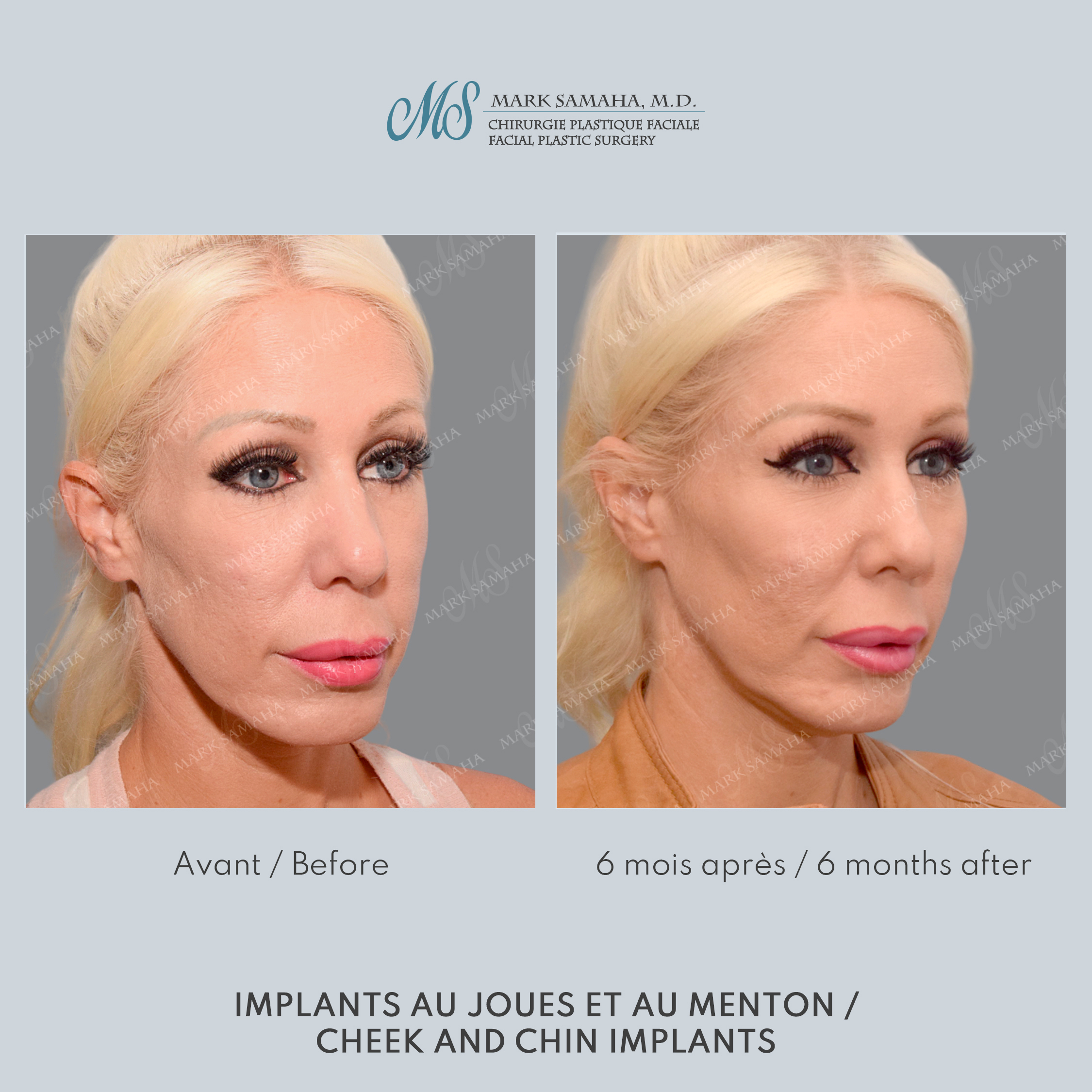 Before & After Implants aux joues / Cheek Implants Case 252 View #4 Detail View in Montreal, QC
