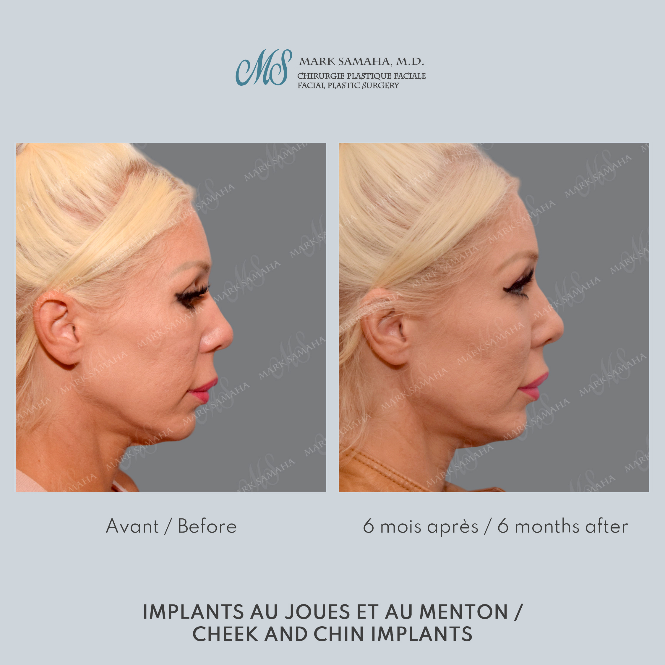 Before & After Implants aux joues / Cheek Implants Case 252 View #5 Detail View in Montreal, QC