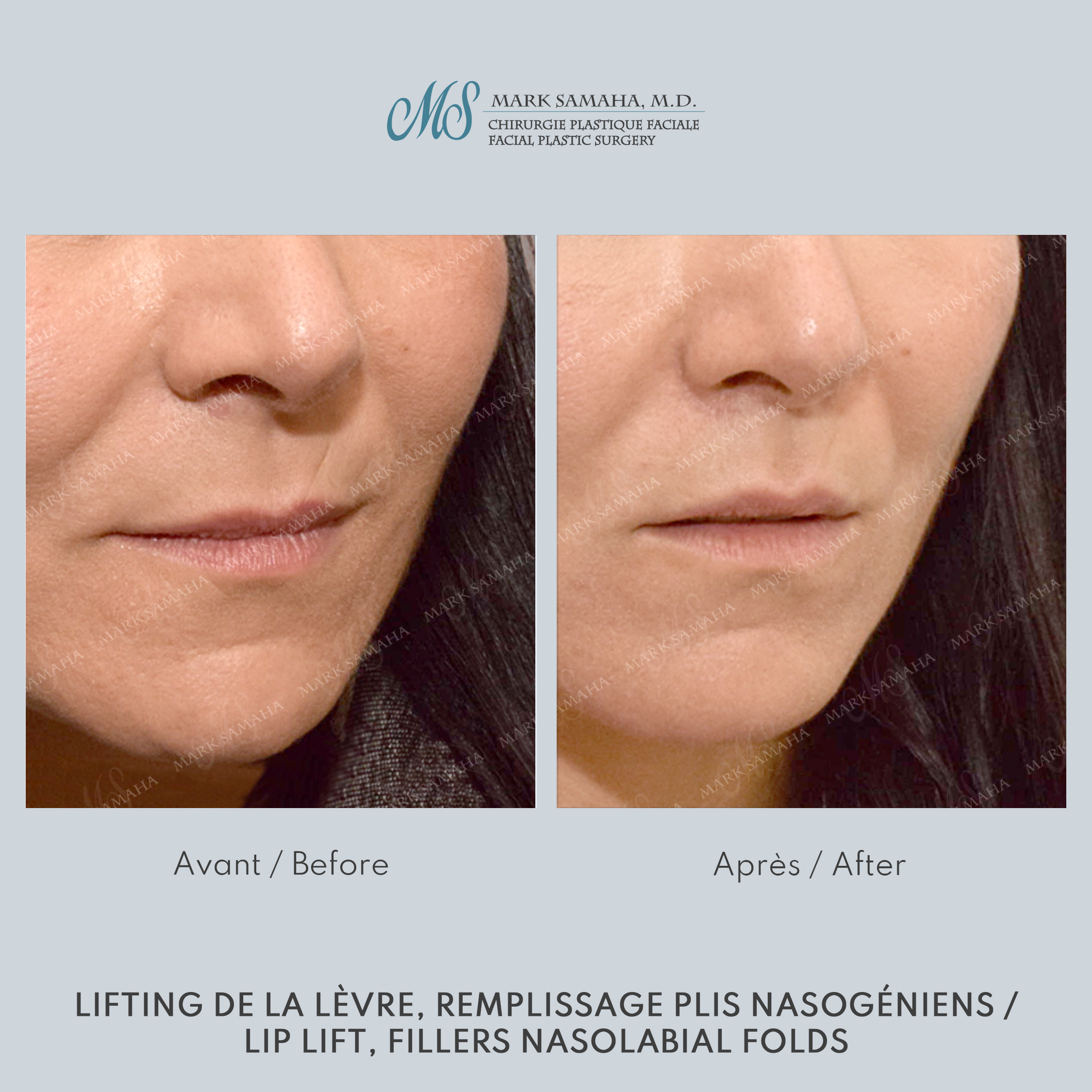 Before & After Lifting de la lèvre supérieure / Lip Lift Case 228 View #1 Detail View in Montreal, QC