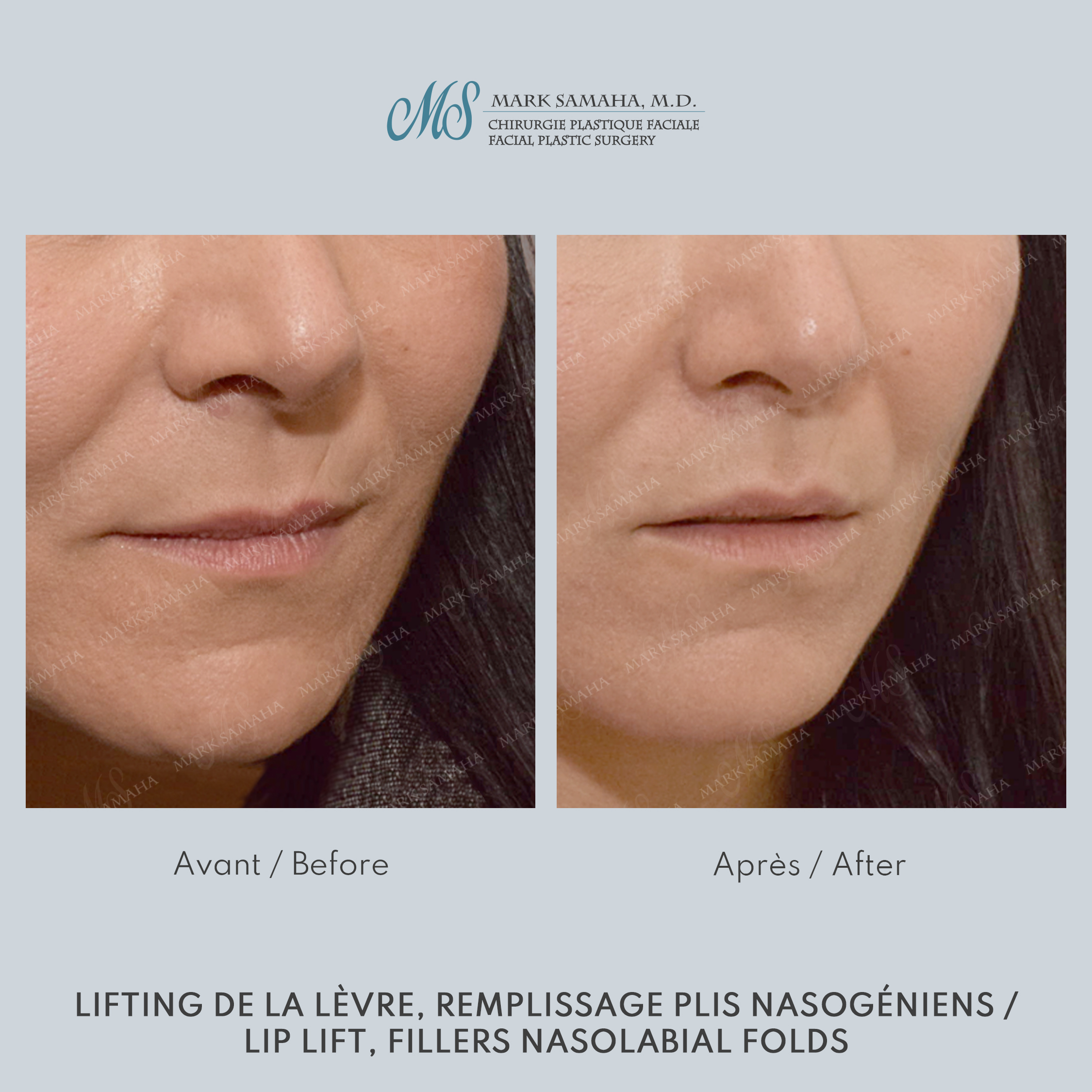 Before & After Lifting de la lèvre supérieure / Lip Lift Case 228 View #1 View in Montreal, QC