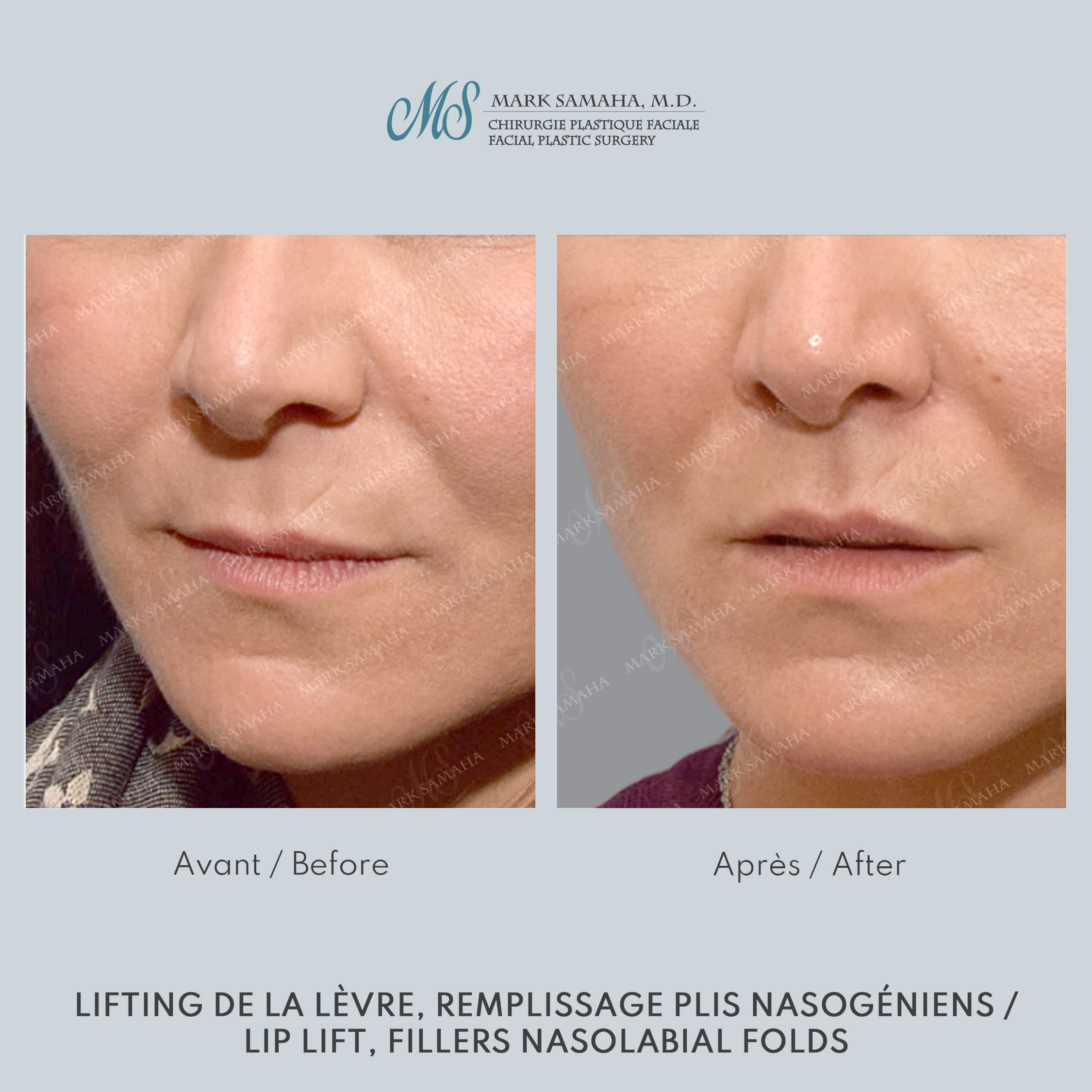 Before & After Lifting de la lèvre supérieure / Lip Lift Case 228 View #2 Detail View in Montreal, QC