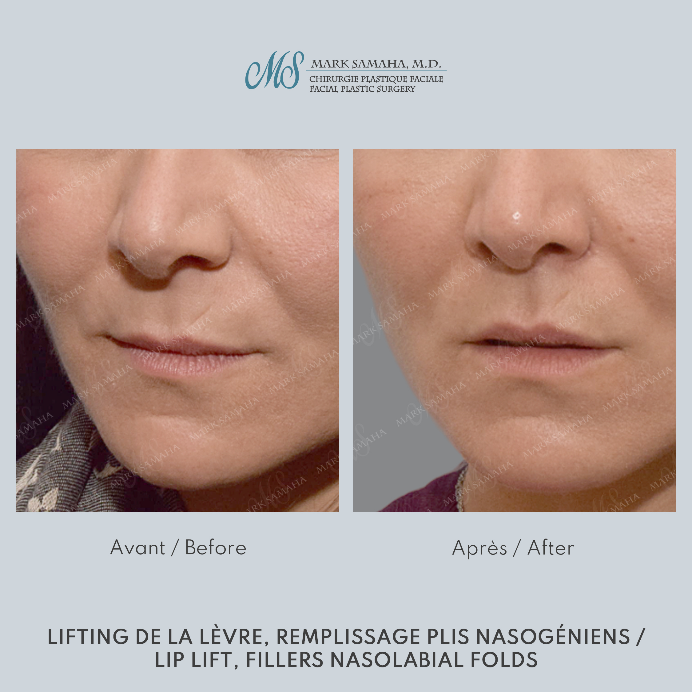 Before & After Lifting de la lèvre supérieure / Lip Lift Case 228 View #2 View in Montreal, QC