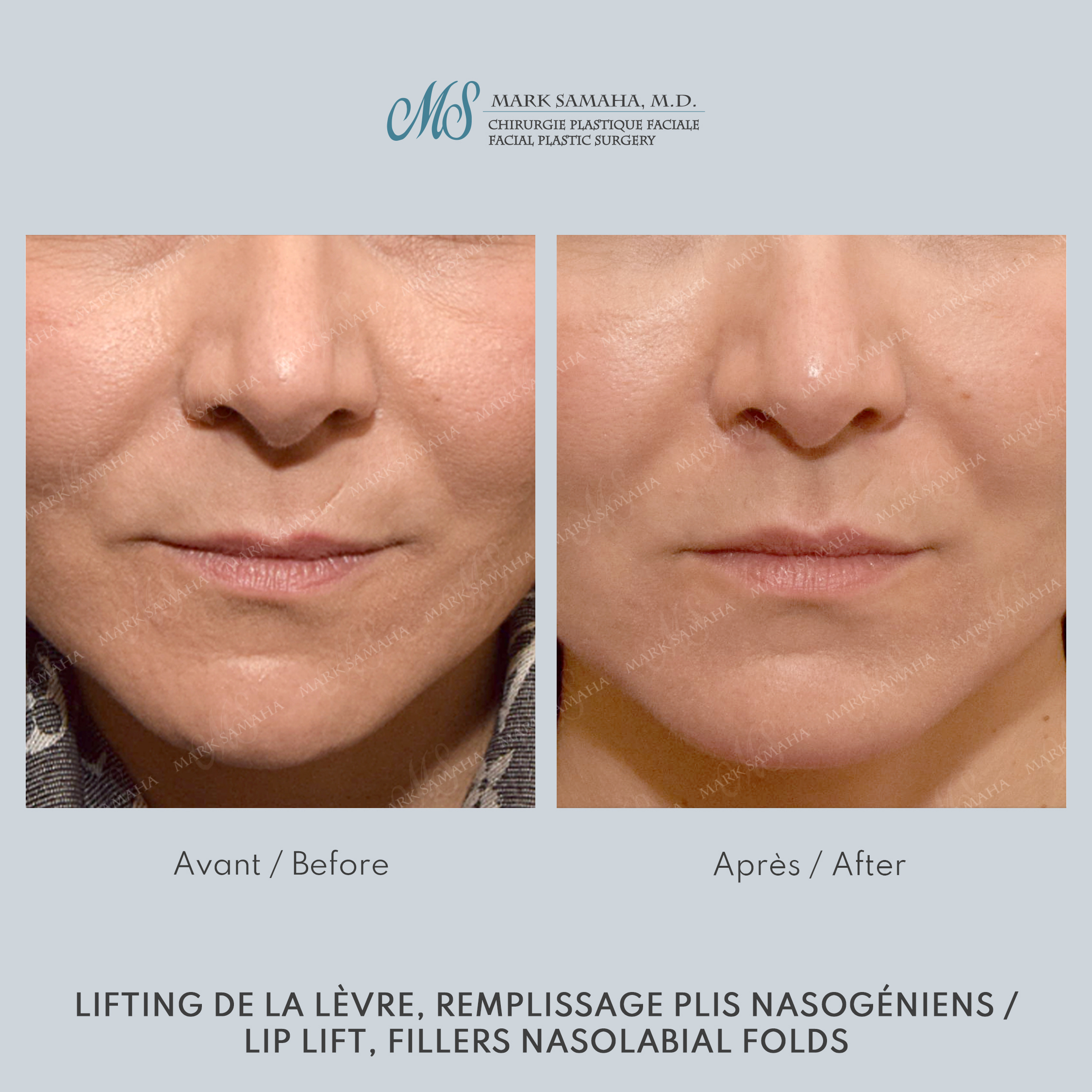 Before & After Lifting de la lèvre supérieure / Lip Lift Case 228 View #3 Detail View in Montreal, QC