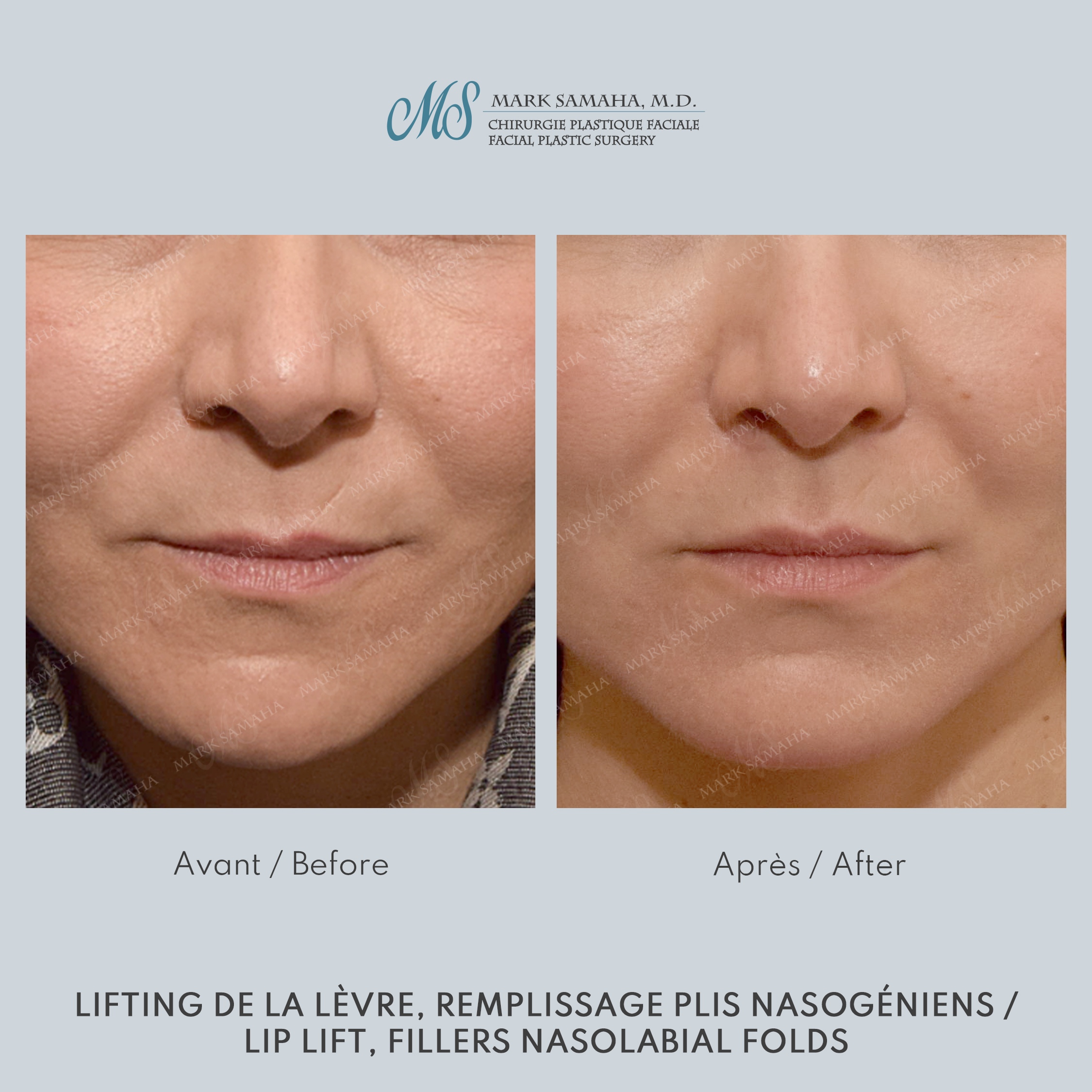 Before & After Lifting de la lèvre supérieure / Lip Lift Case 228 View #3 View in Montreal, QC