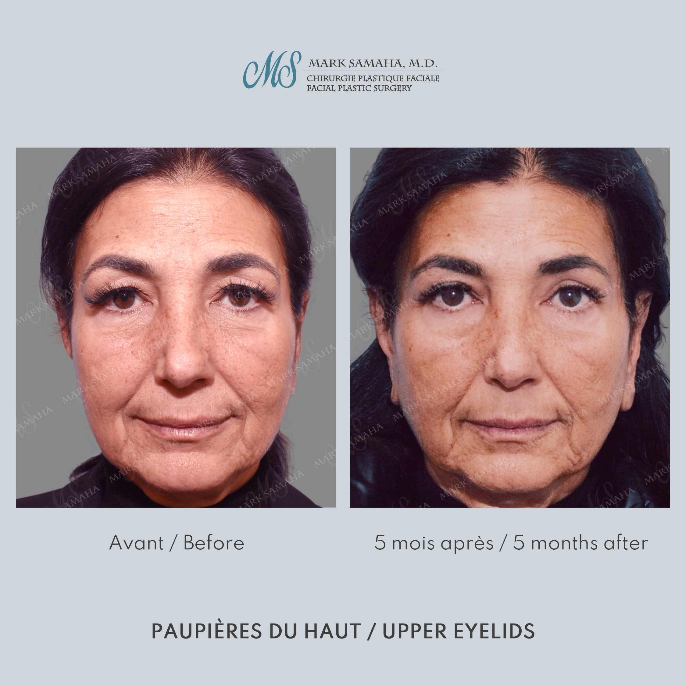 Before & After Blépharoplastie / Blepharoplasty Case 210 View #2 View in Montreal, QC