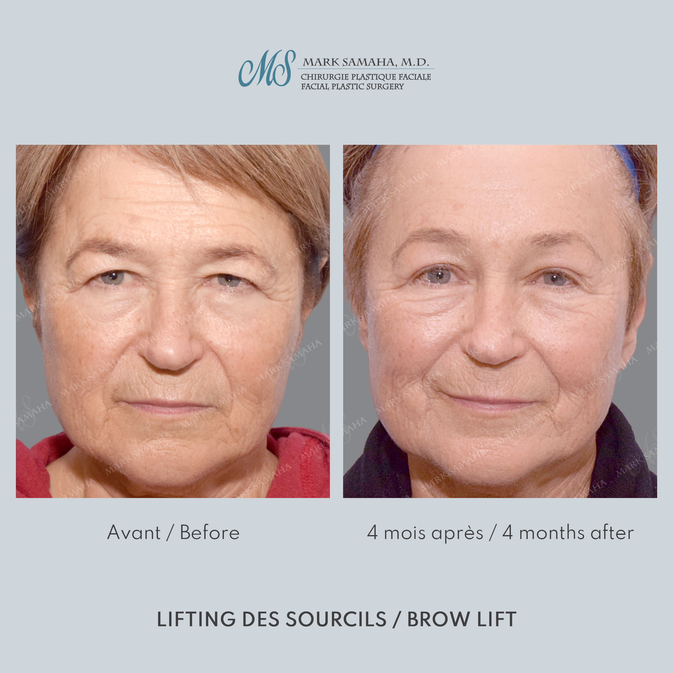 Before & After Lifting du Sourcil / Brow lift Case 218 View #1 Detail View in Montreal, QC