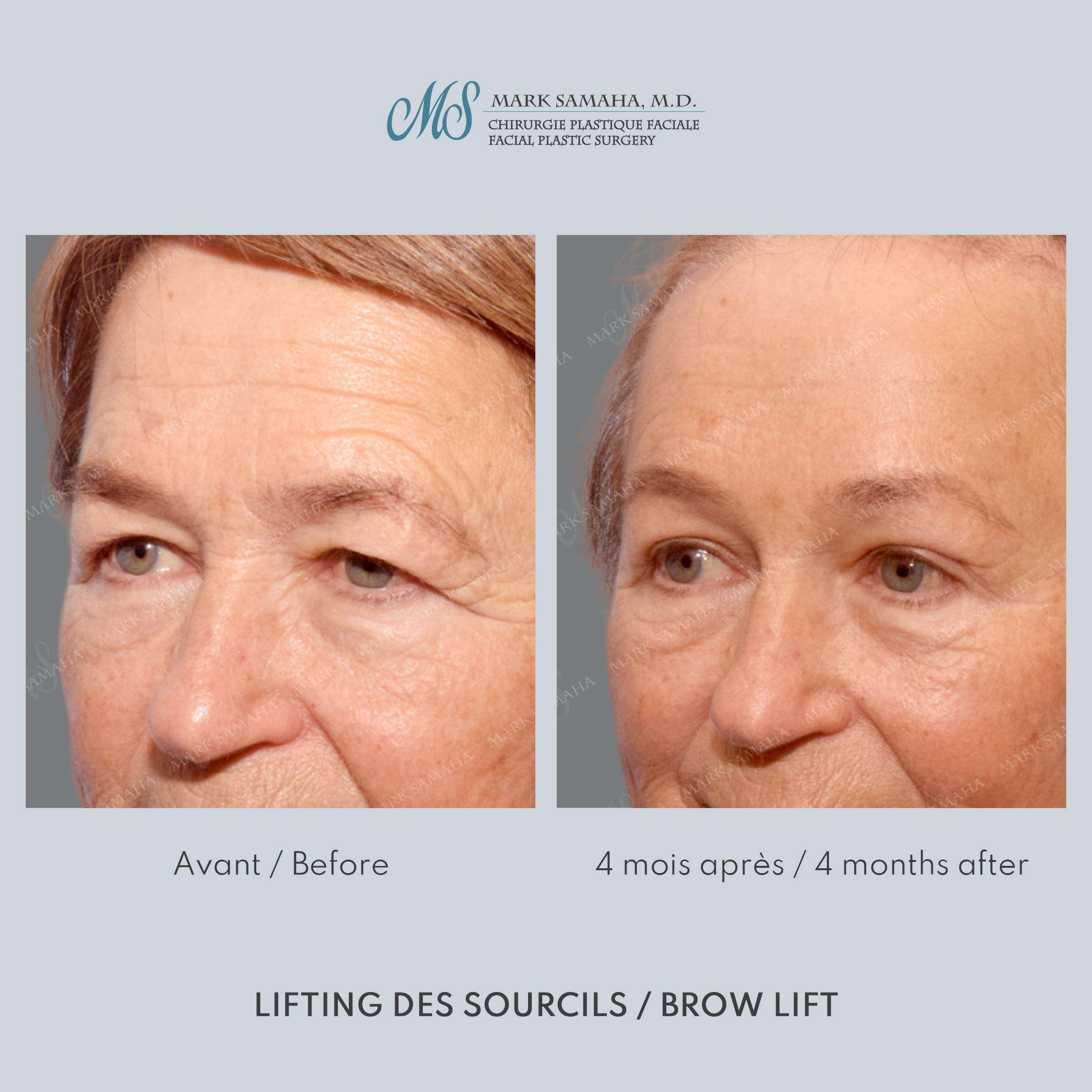 Before & After Lifting du Sourcil / Brow lift Case 218 View #2 Detail View in Montreal, QC