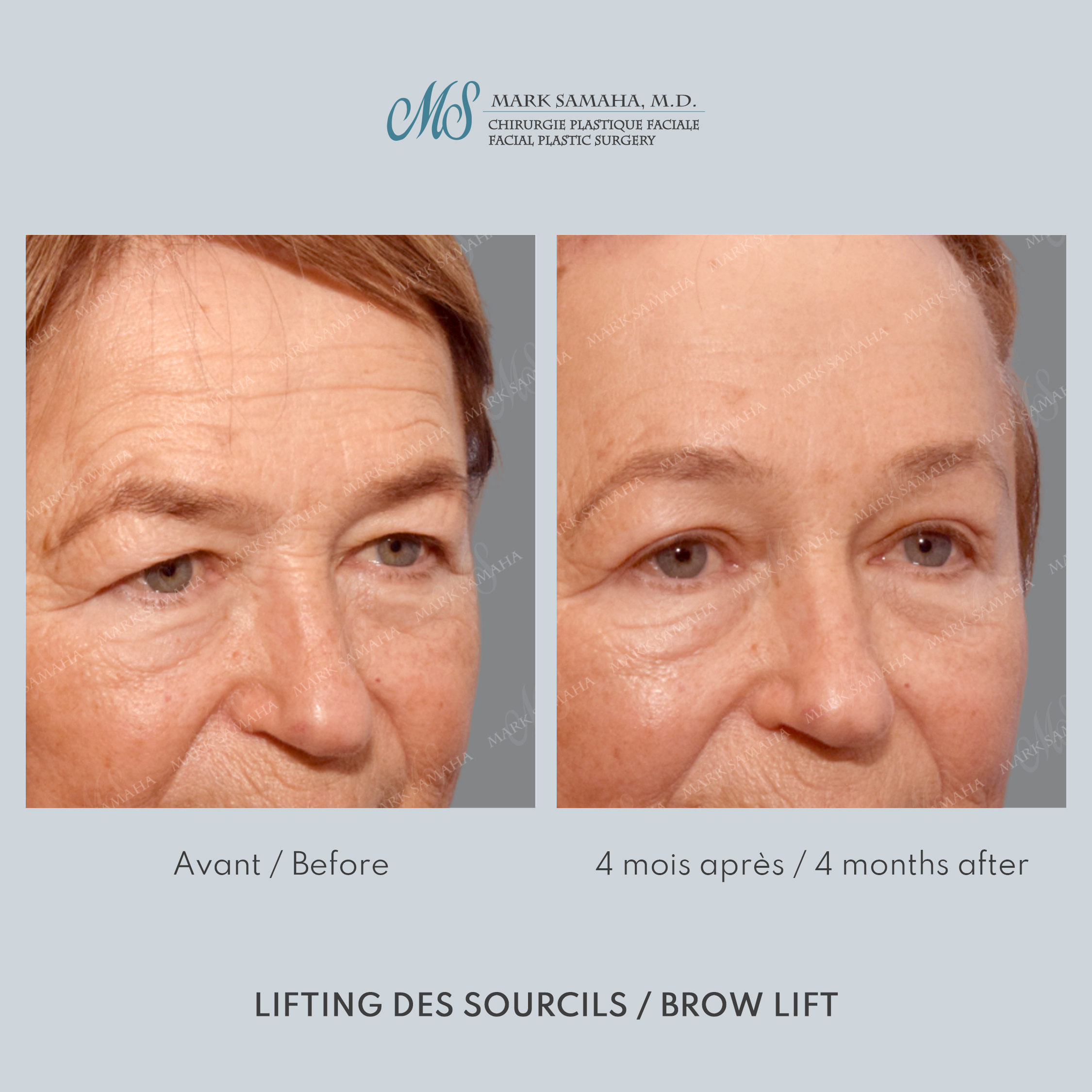 Before & After Lifting du Sourcil / Brow lift Case 218 View #3 Detail View in Montreal, QC