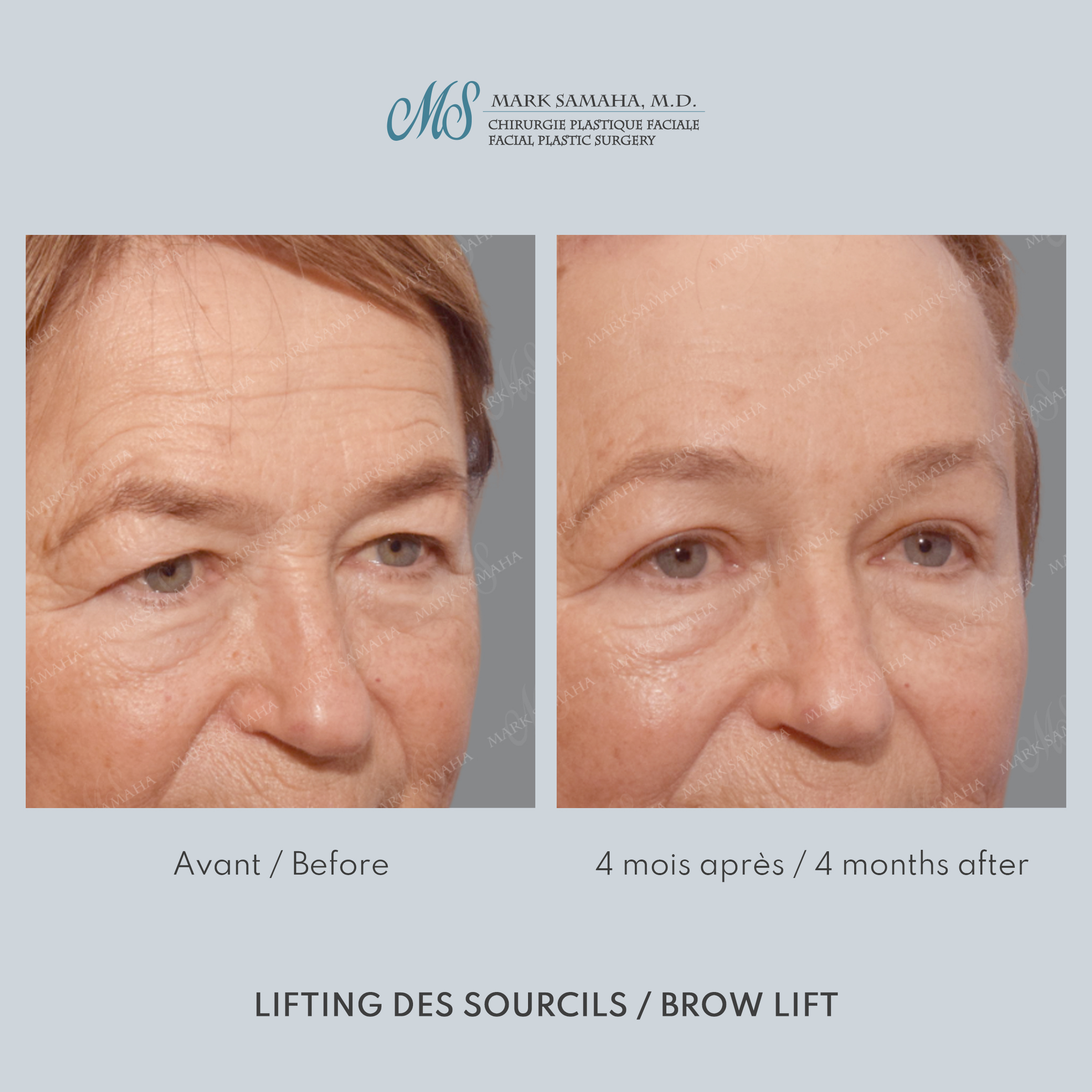 Before & After Lifting du Sourcil / Brow lift Case 218 View #3 View in Montreal, QC