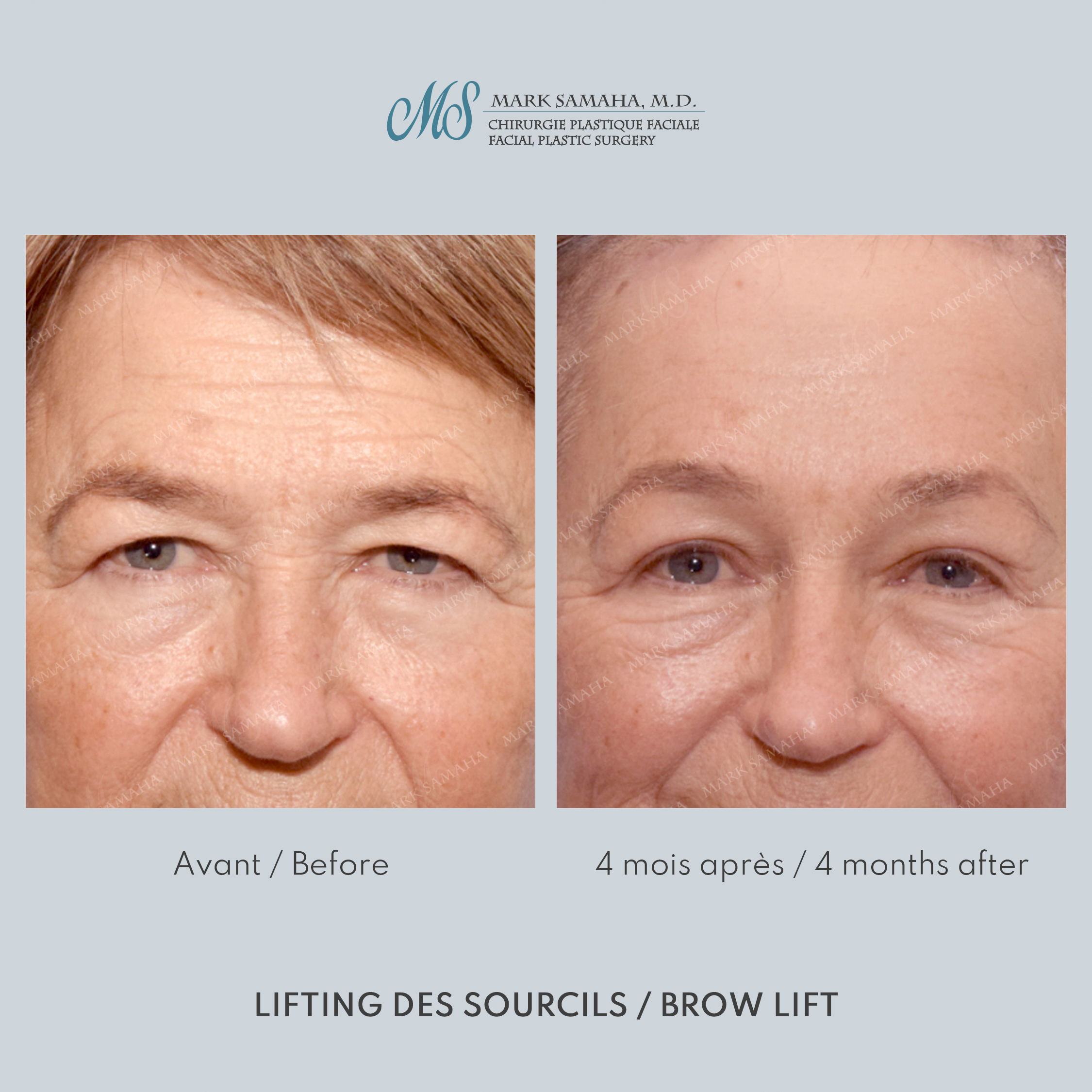 Before & After Lifting du Sourcil / Brow lift Case 218 View #4 Detail View in Montreal, QC