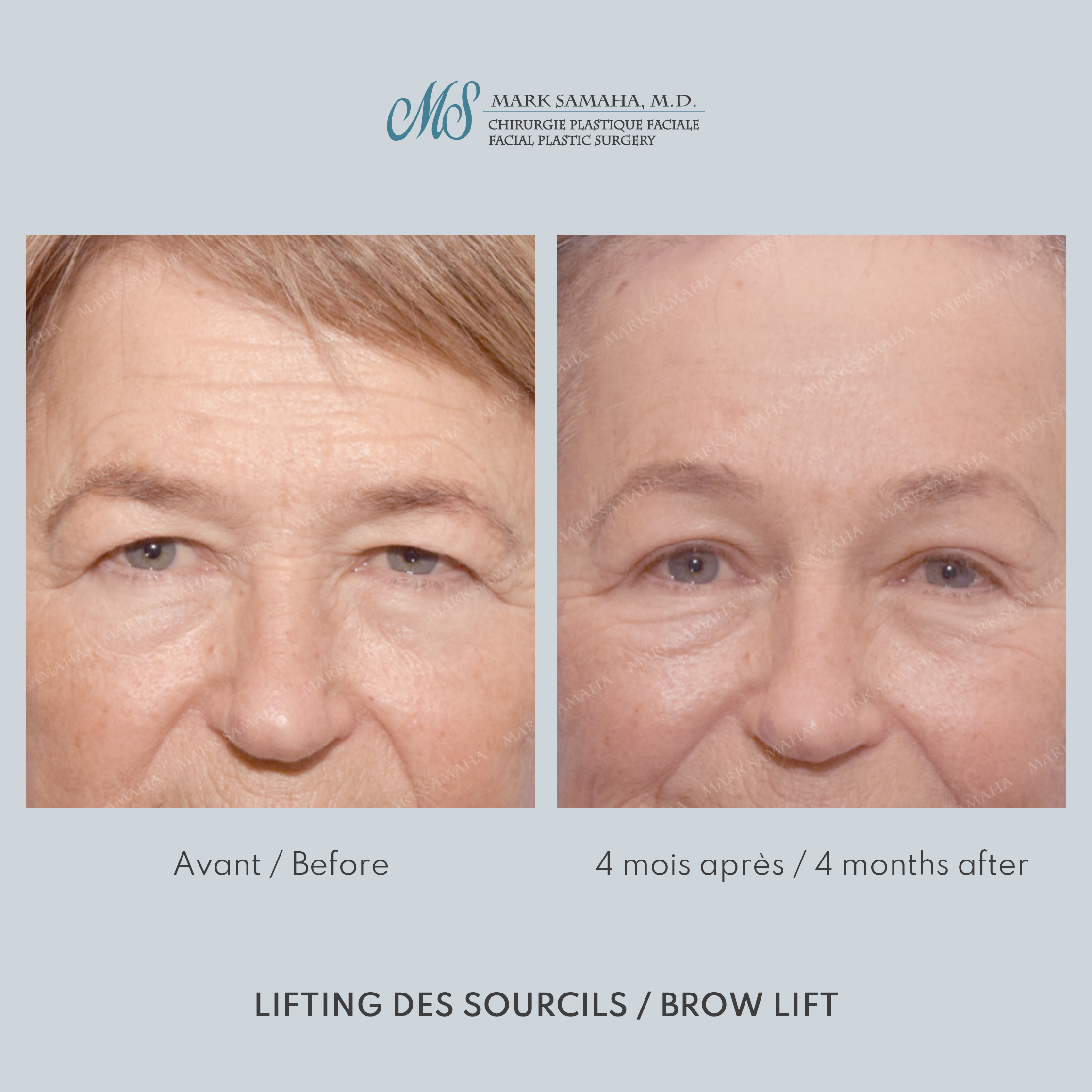 Before & After Lifting du Sourcil / Brow lift Case 218 View #4 View in Montreal, QC
