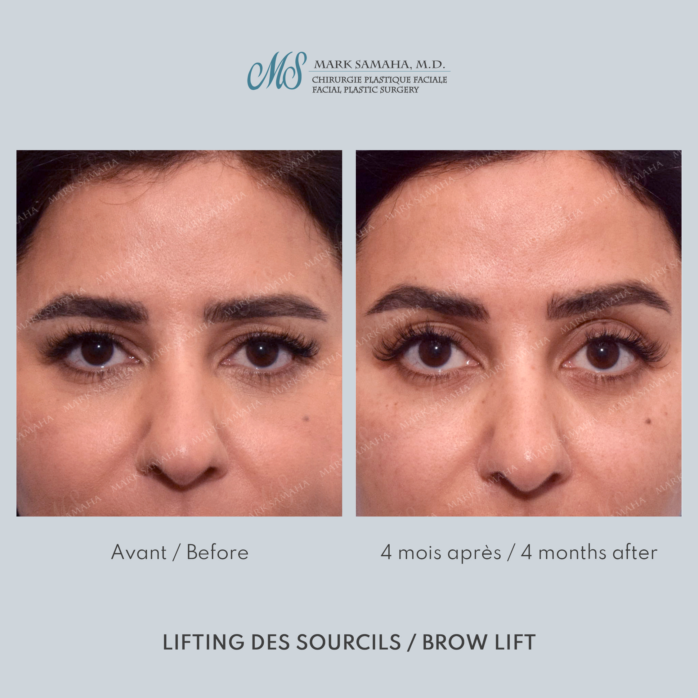 Before & After Lifting du Sourcil / Brow lift Case 219 View #1 Detail View in Montreal, QC