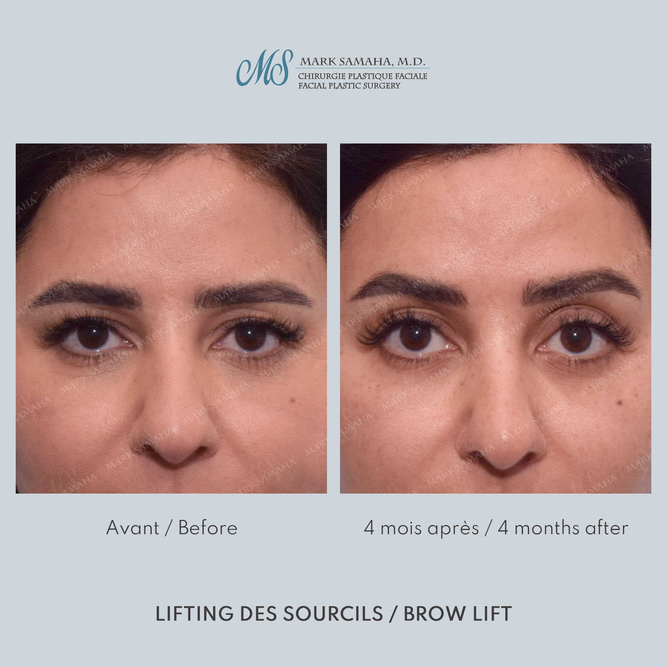 Before & After Lifting du Sourcil / Brow lift Case 219 View #1 View in Montreal, QC