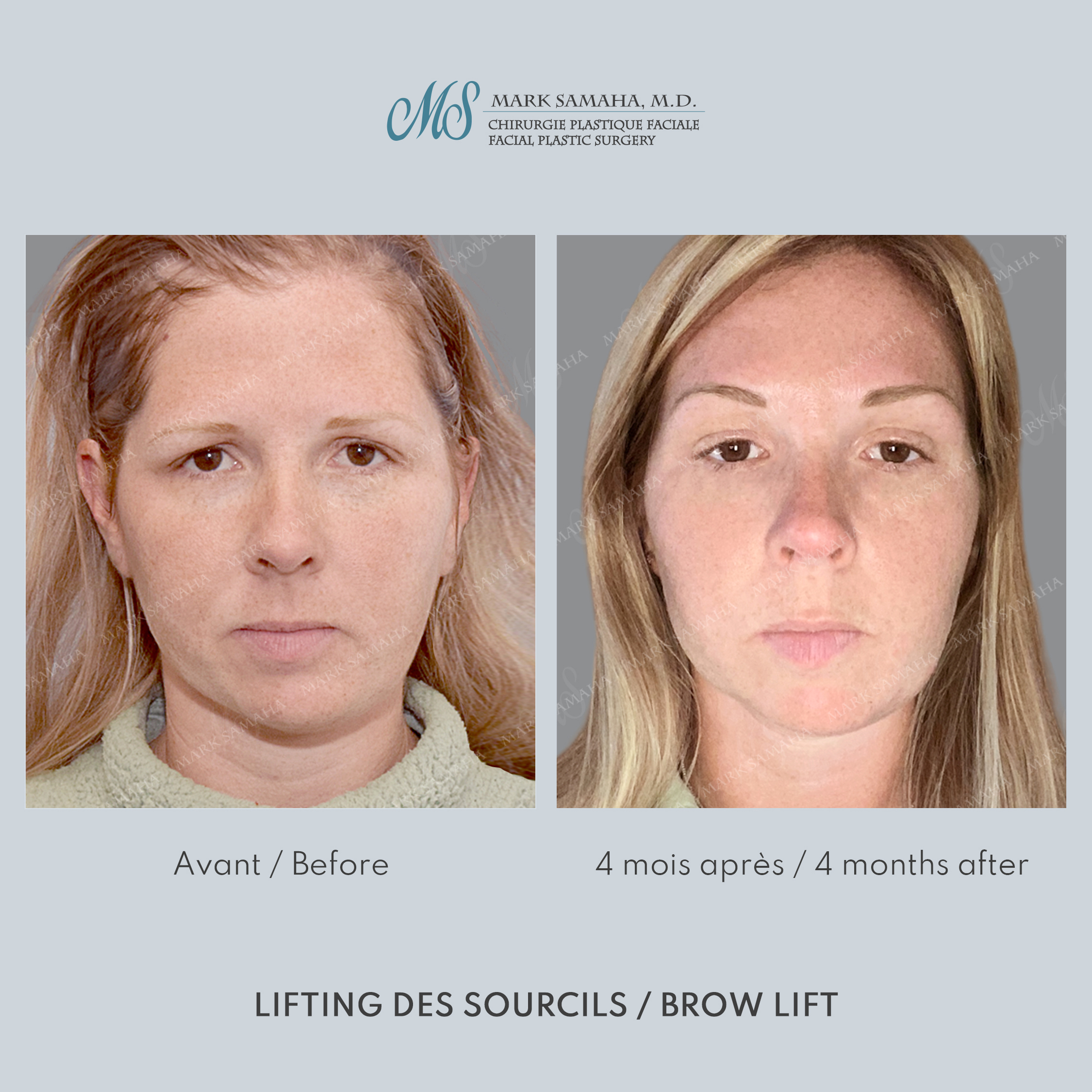 Before & After Lifting du Sourcil / Brow lift Case 220 View #1 Detail View in Montreal, QC