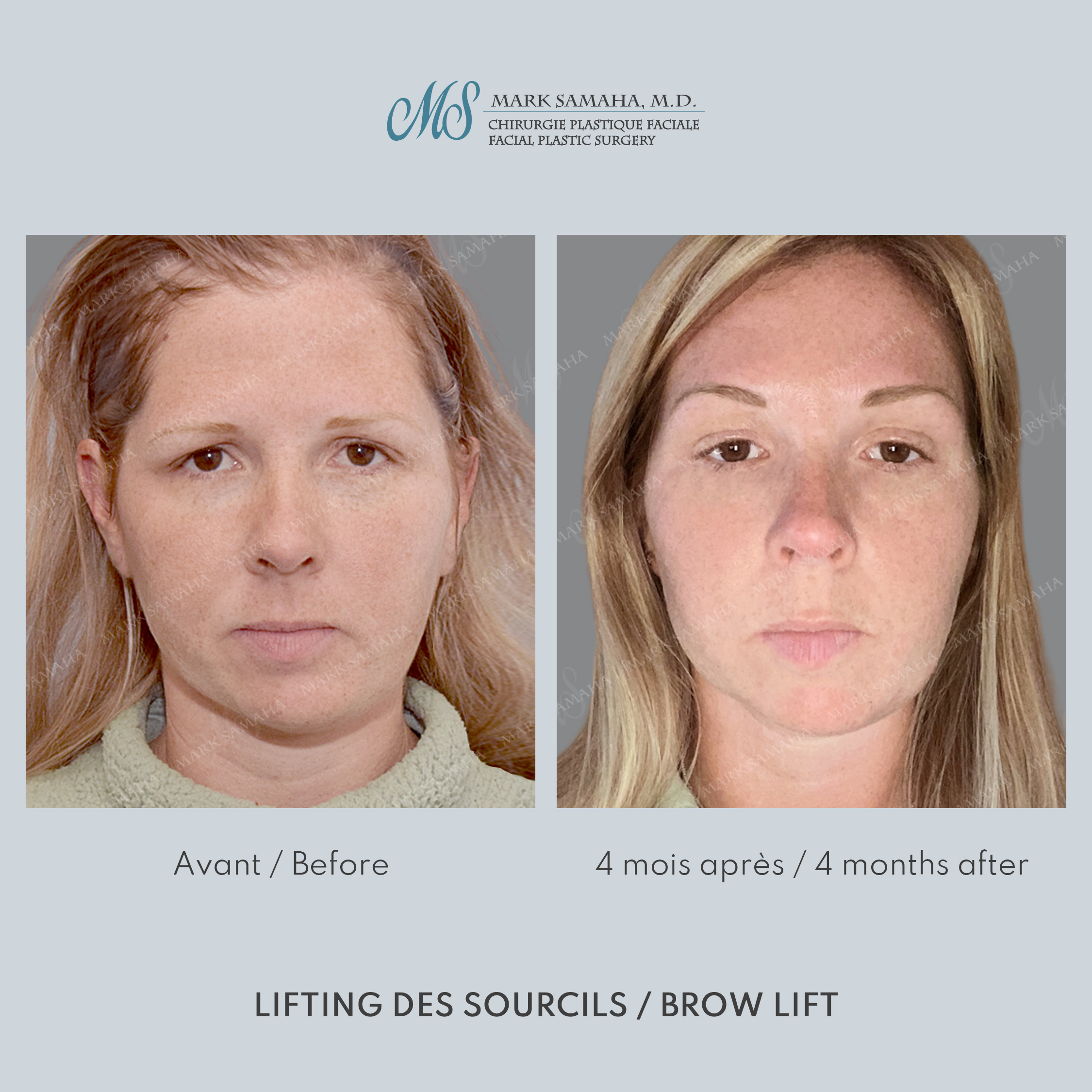 Before & After Lifting du Sourcil / Brow lift Case 220 View #1 View in Montreal, QC