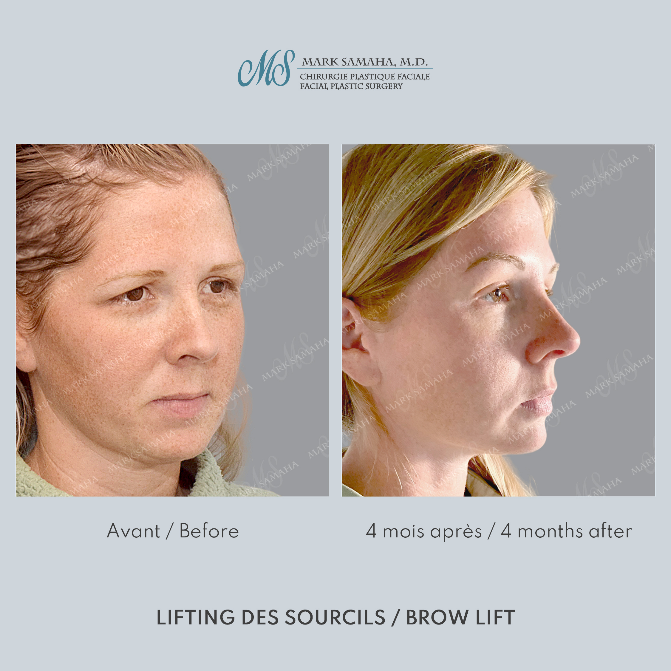 Before & After Lifting du Sourcil / Brow lift Case 220 View #2 Detail View in Montreal, QC