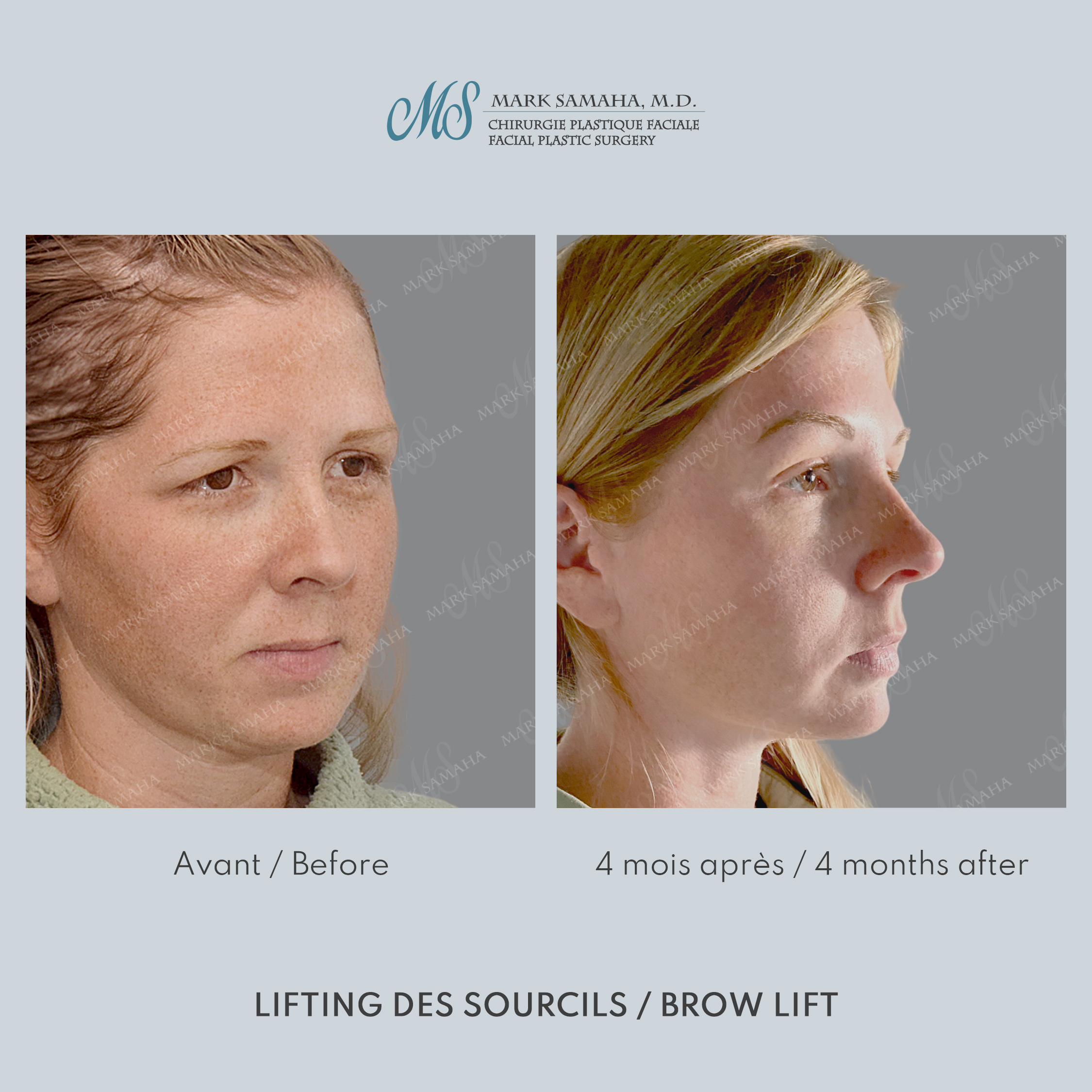 Before & After Lifting du Sourcil / Brow lift Case 220 View #2 View in Montreal, QC