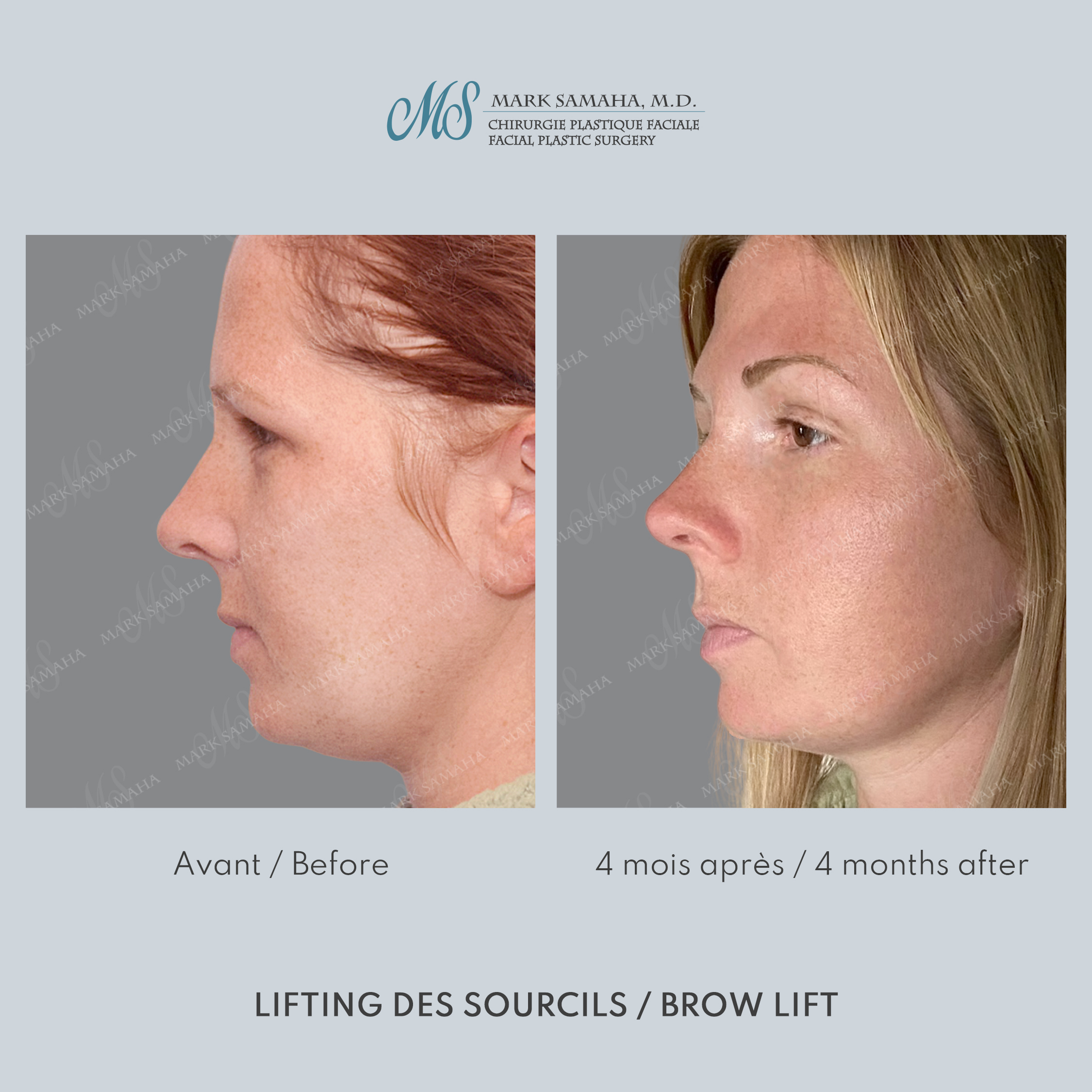 Before & After Lifting du Sourcil / Brow lift Case 220 View #3 View in Montreal, QC