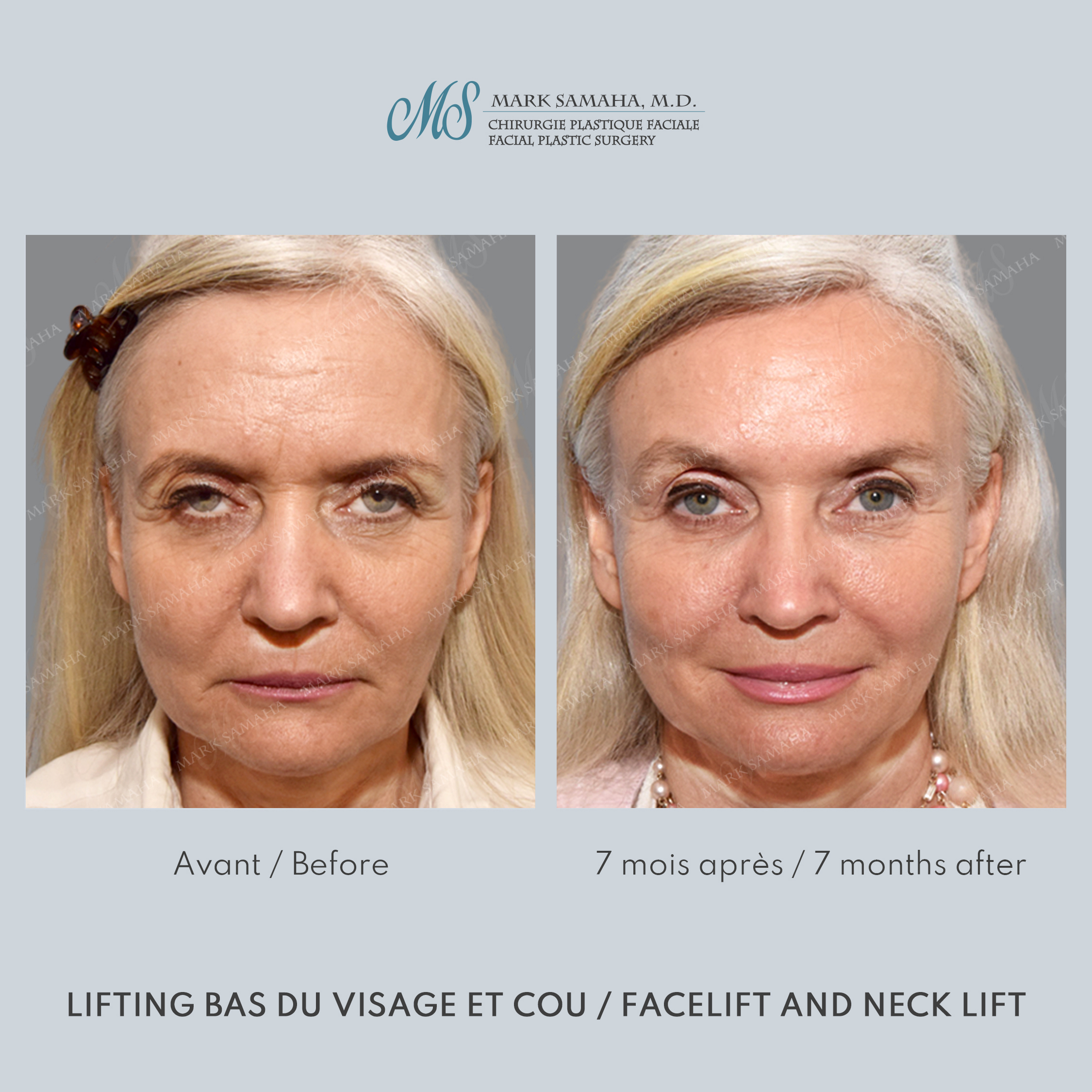 Before & After Lifting du Sourcil / Brow lift Case 221 View #1 Detail View in Montreal, QC