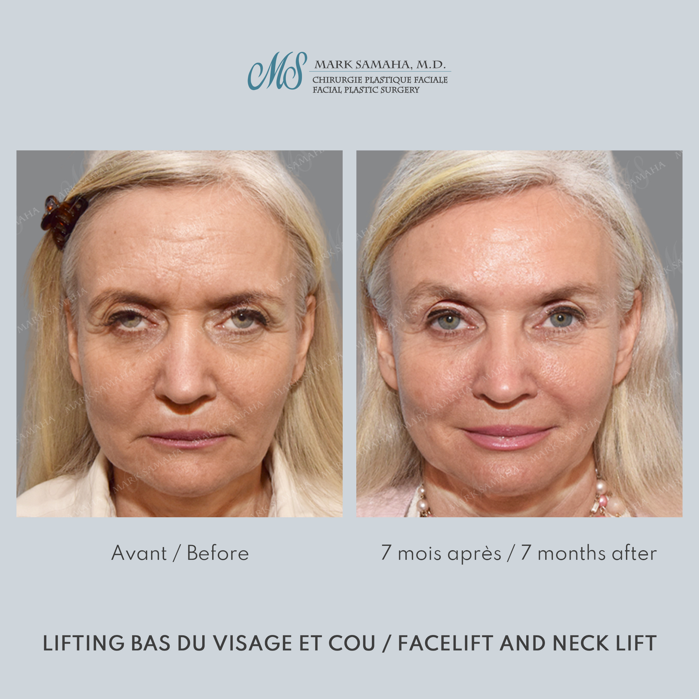 Before & After Lifting du Sourcil / Brow lift Case 221 View #1 View in Montreal, QC
