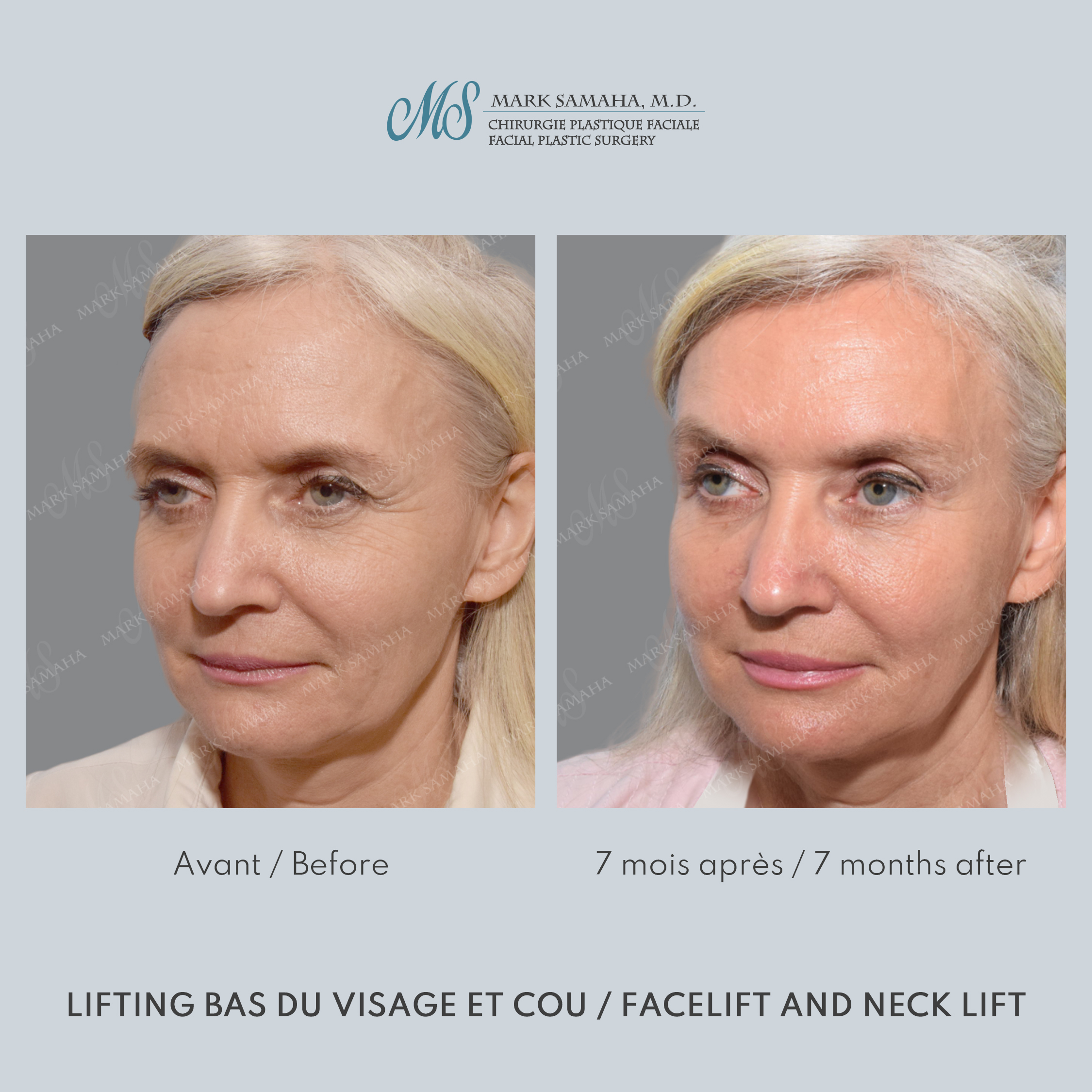 Before & After Lifting du Sourcil / Brow lift Case 221 View #2 View in Montreal, QC