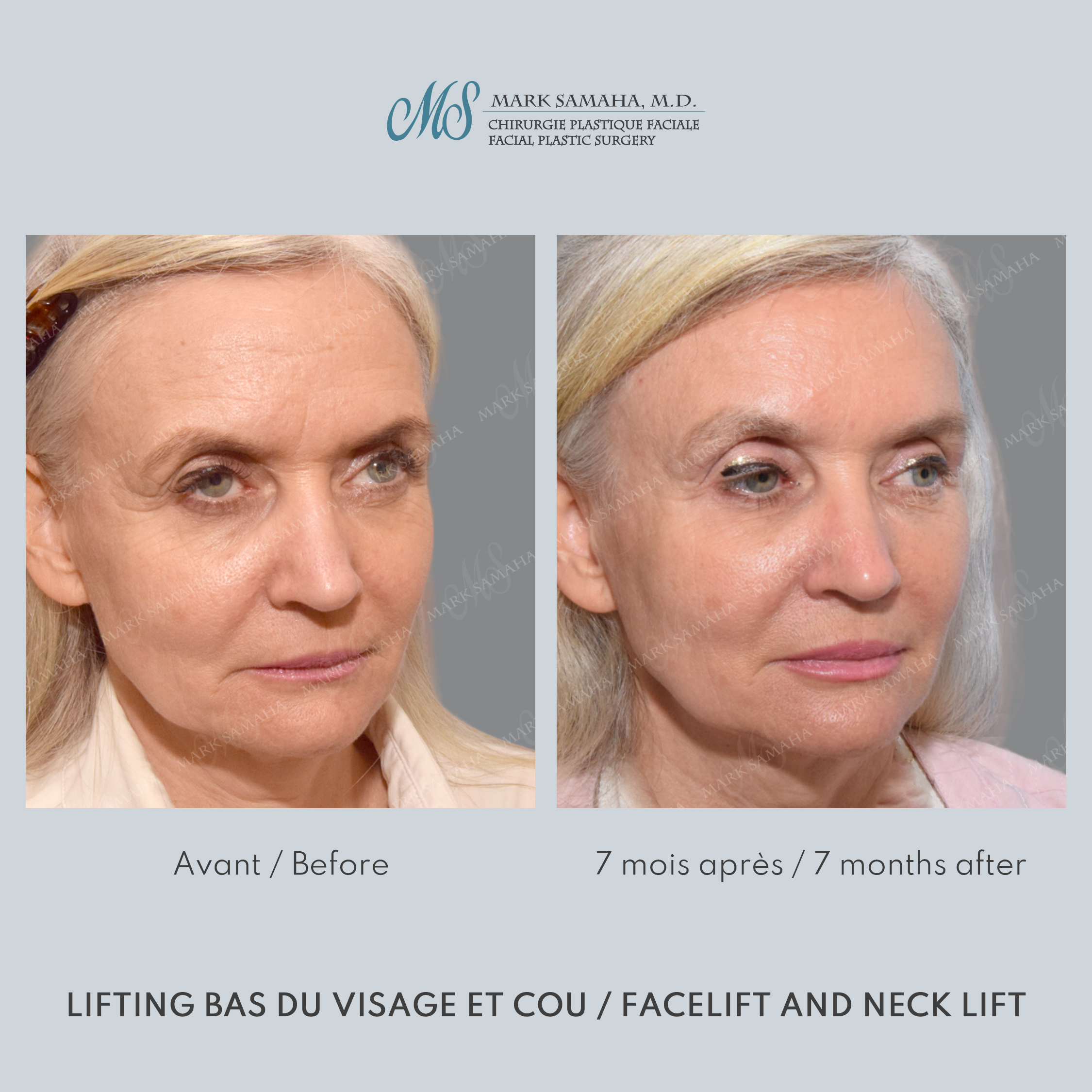 Before & After Lifting du Sourcil / Brow lift Case 221 View #3 View in Montreal, QC