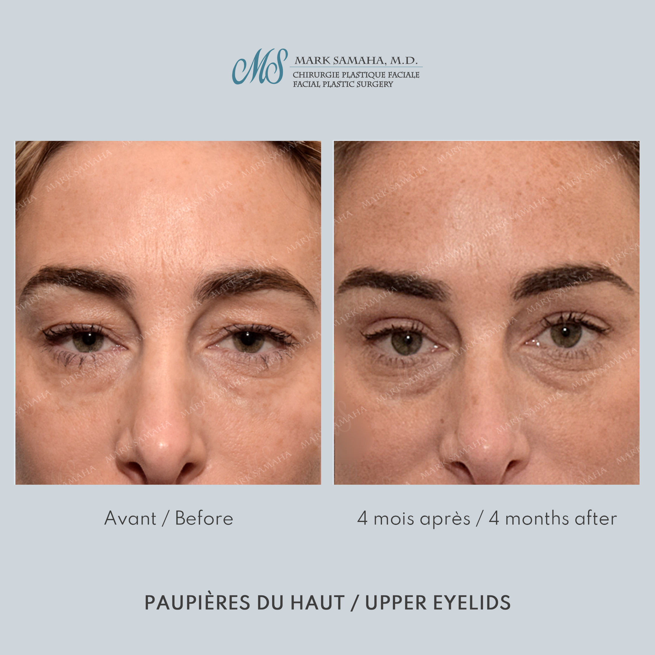 Before & After Blépharoplastie / Blepharoplasty Case 234 View #1 Detail View in Montreal, QC