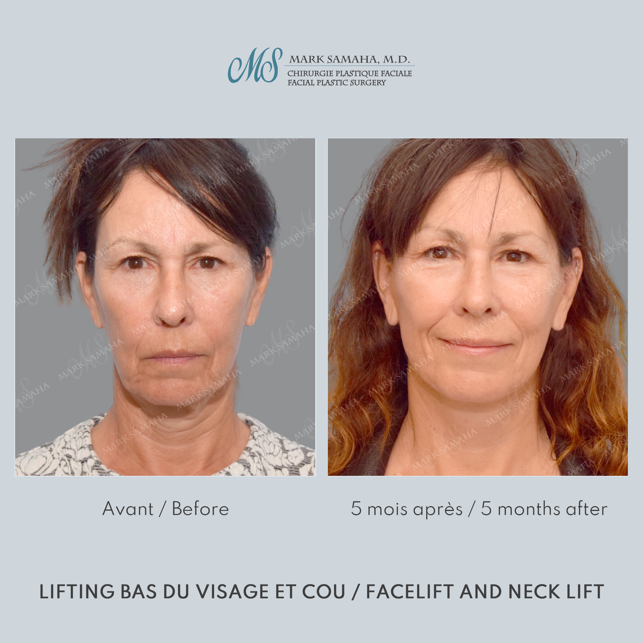 Before & After Lifting du visage / Cou - Facelift / Necklift Case 209 View #1 Detail View in Montreal, QC
