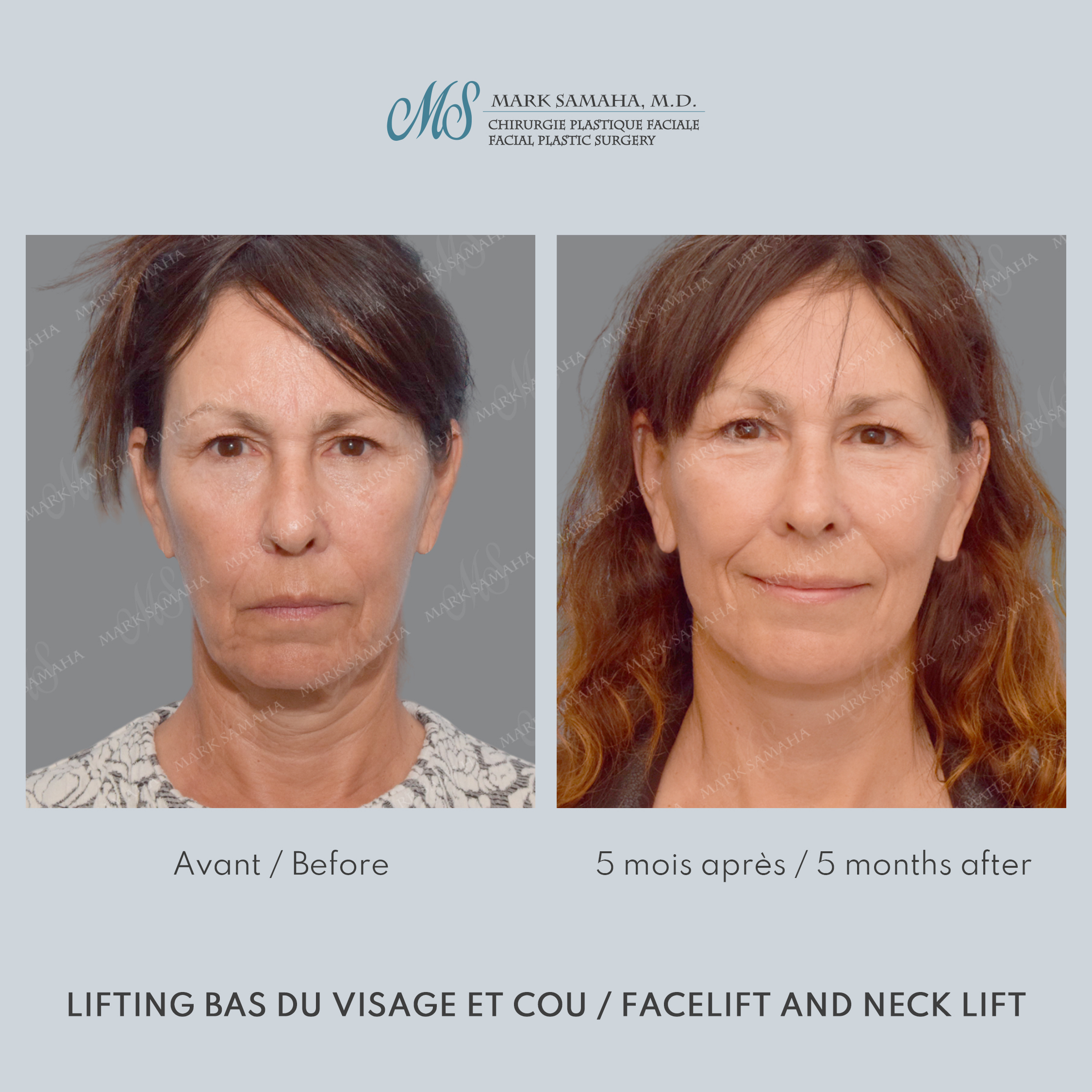 Before & After Lifting du visage / Cou - Facelift / Necklift Case 209 View #1 View in Montreal, QC