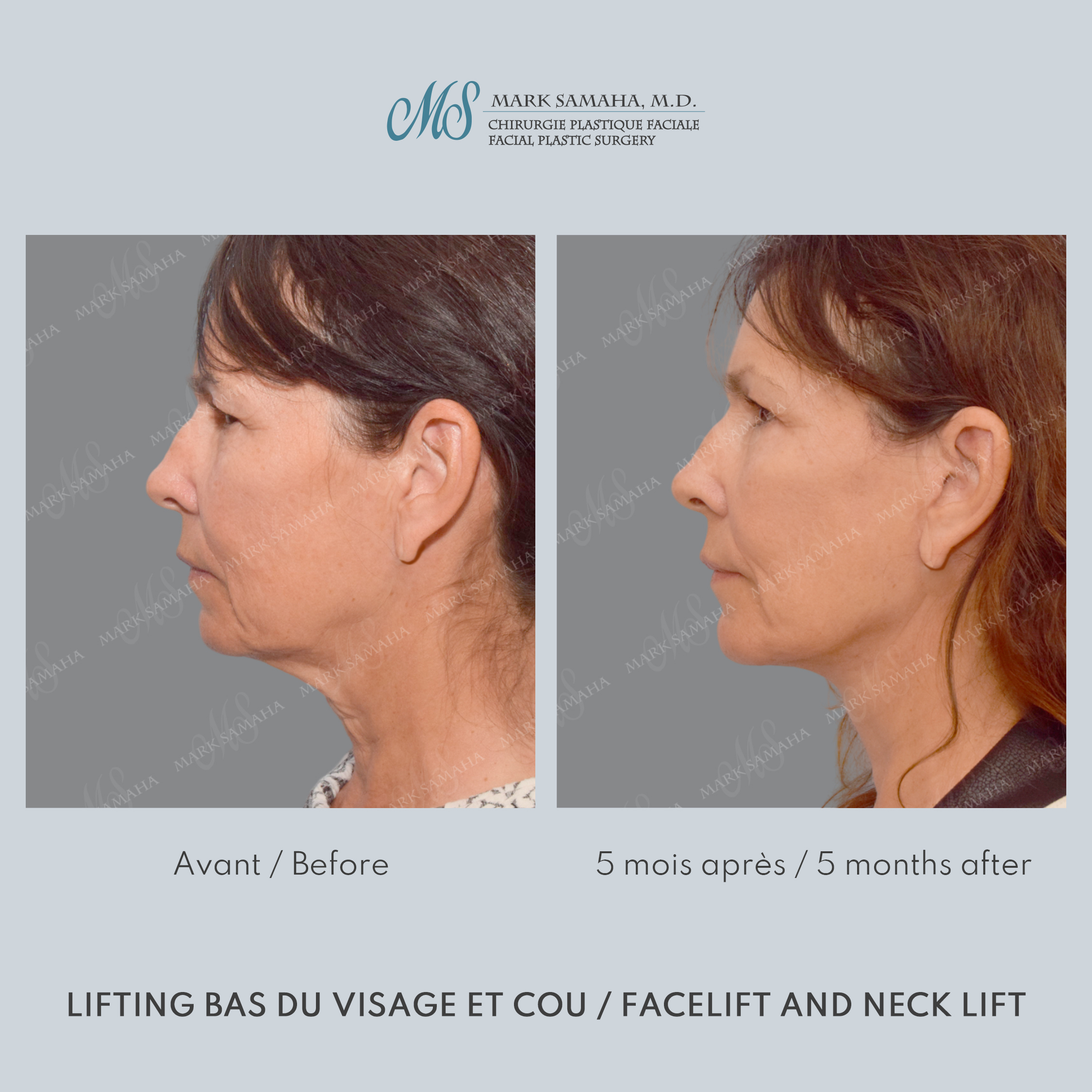 Before & After Lifting du visage / Cou - Facelift / Necklift Case 209 View #2 View in Montreal, QC