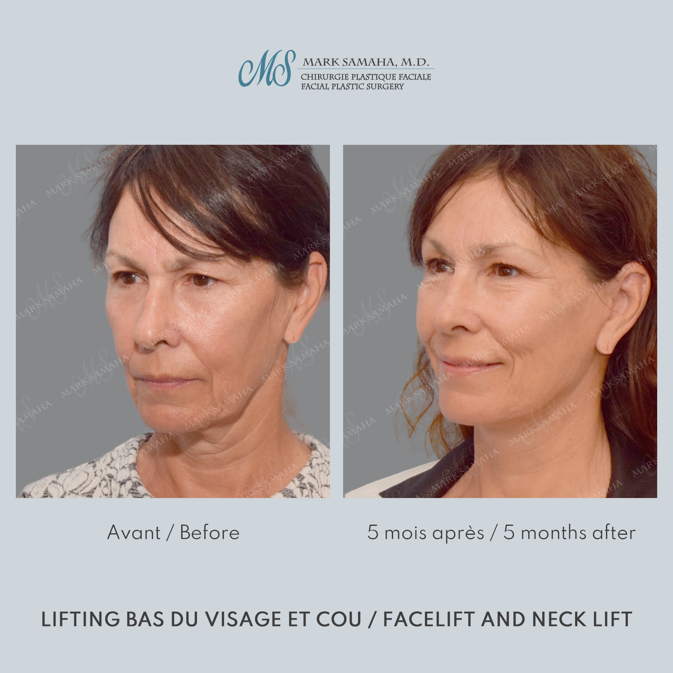 Before & After Lifting du visage / Cou - Facelift / Necklift Case 209 View #3 View in Montreal, QC