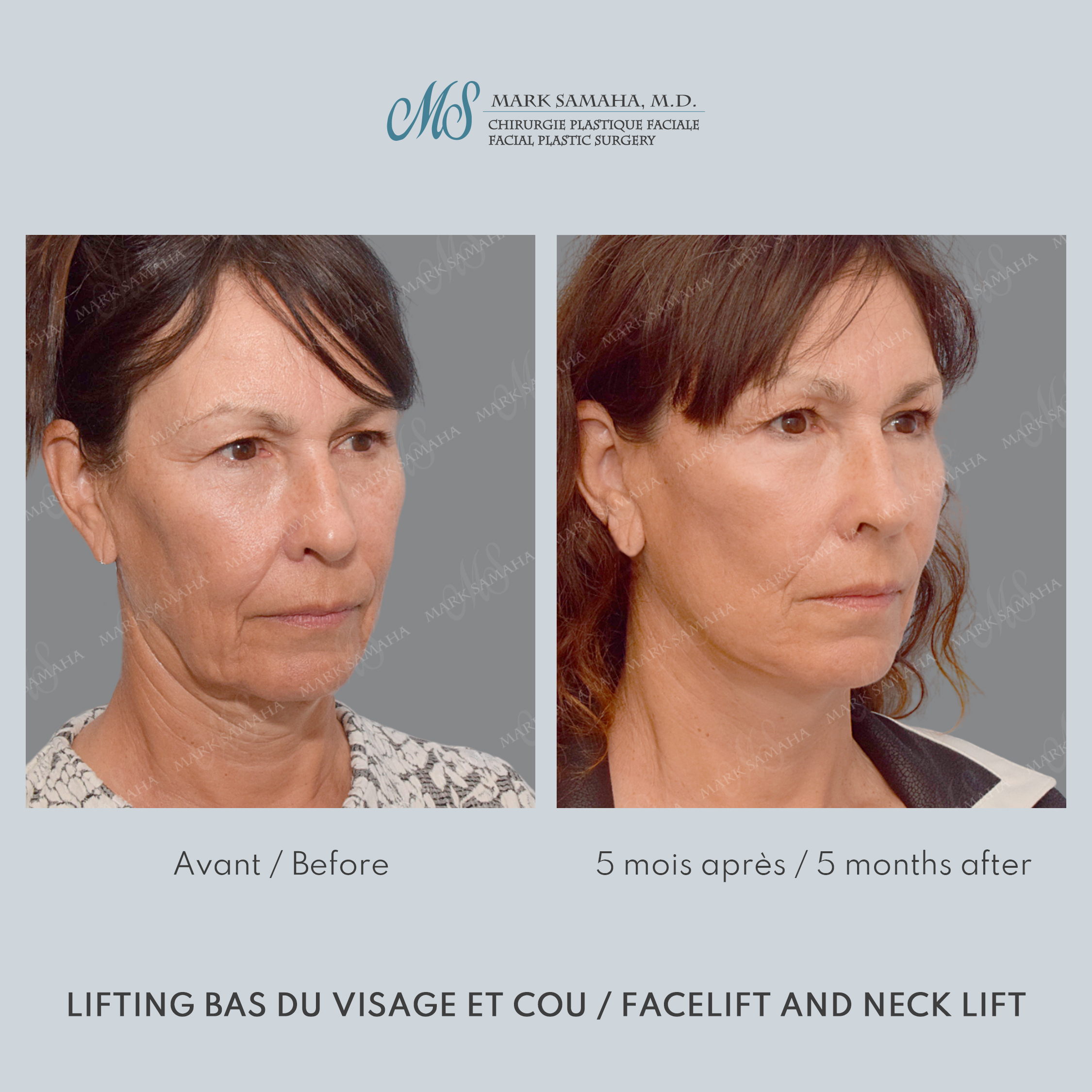 Before & After Lifting du visage / Cou - Facelift / Necklift Case 209 View #4 View in Montreal, QC