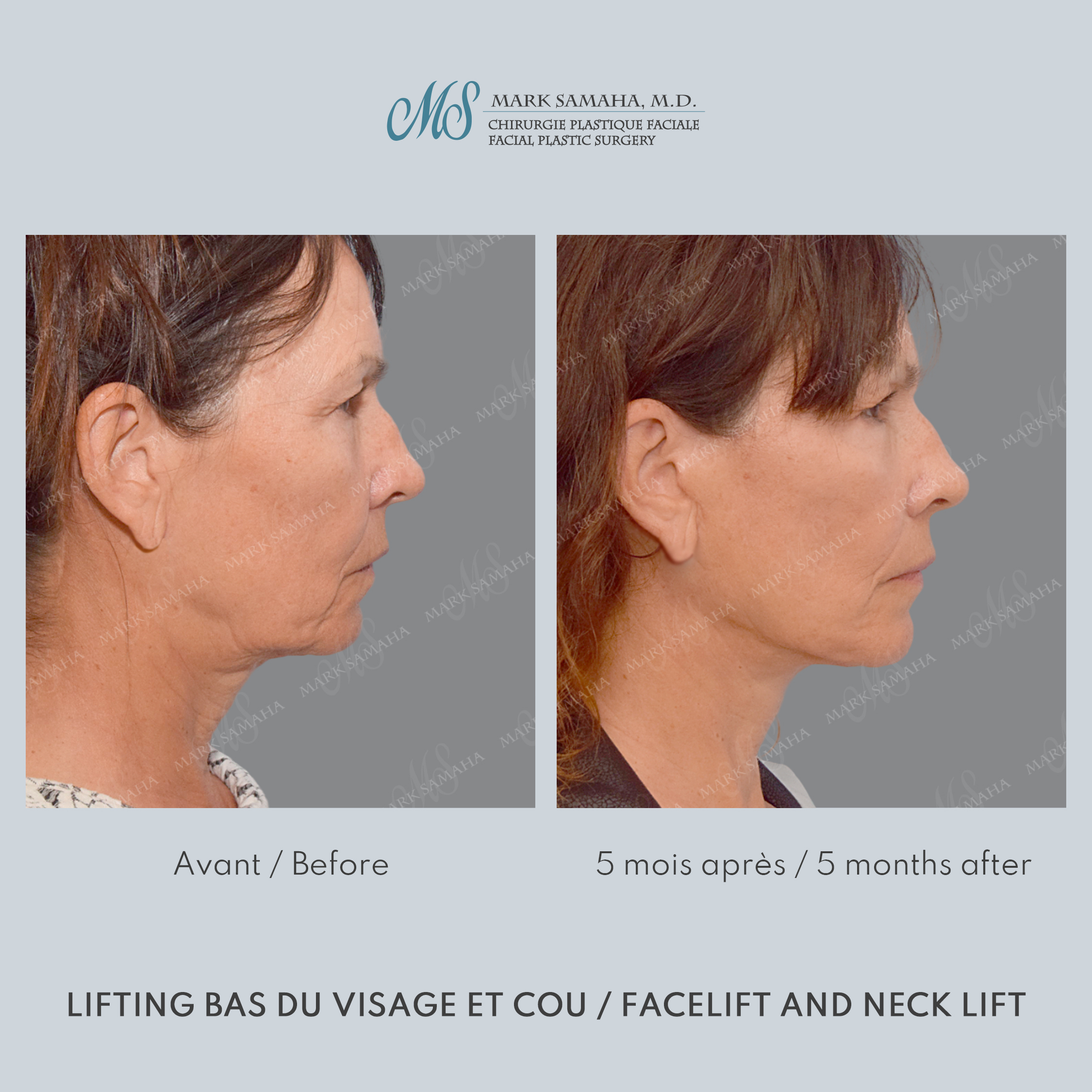 Before & After Lifting du visage / Cou - Facelift / Necklift Case 209 View #5 View in Montreal, QC