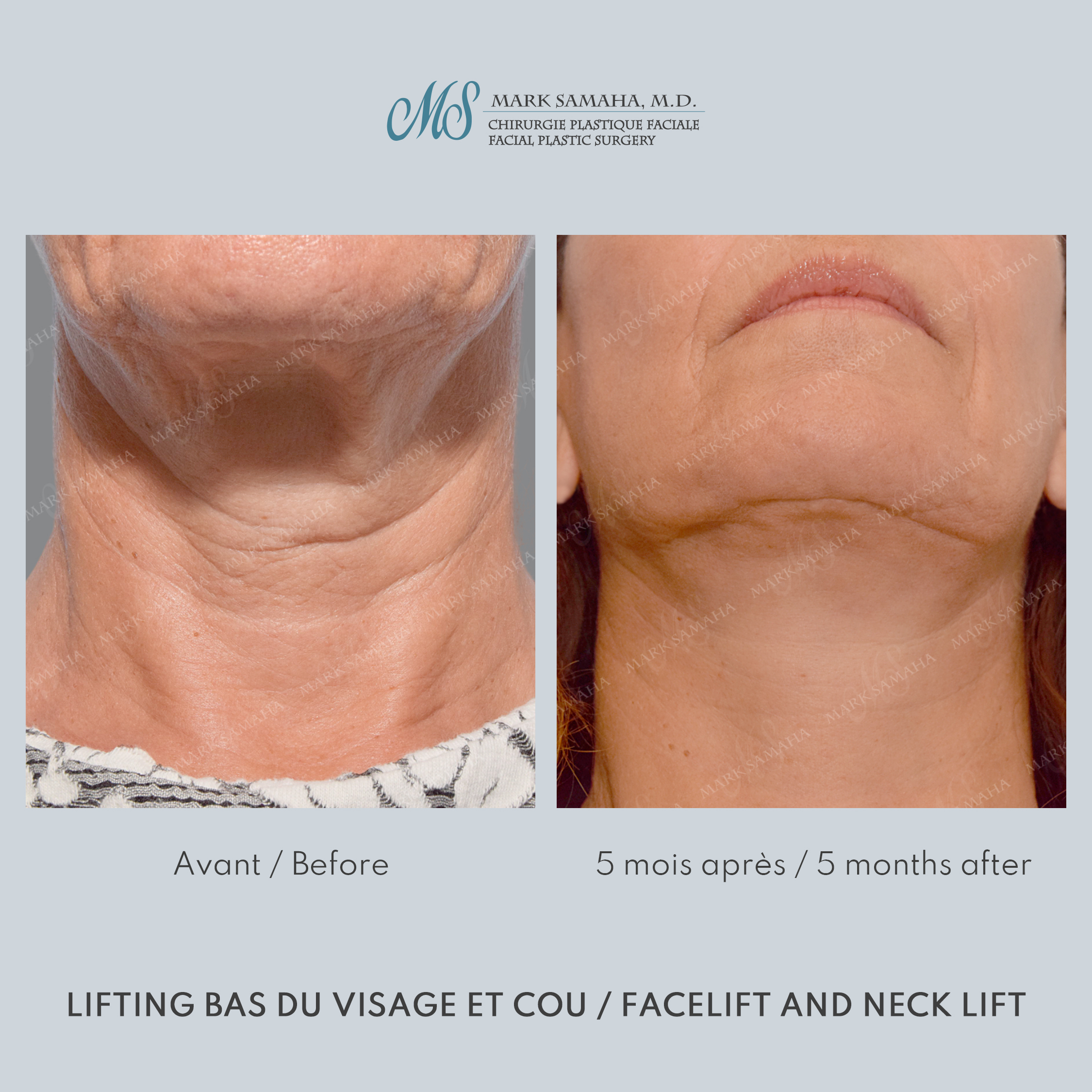 Before & After Lifting du visage / Cou - Facelift / Necklift Case 209 View #6 View in Montreal, QC
